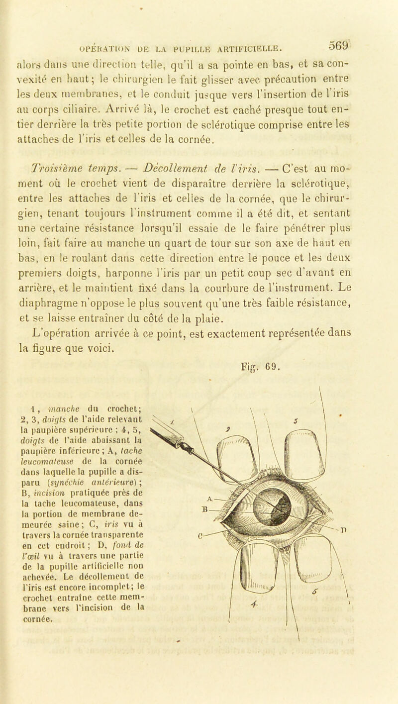 alors dans une direciion telle, qu’il a sa pointe en bas, et sa con- vexité en haut; le chirurgien le fait glisser avec précaution entre les deux membranes, et le conduit jusque vers l’insertion de l’iris au corps ciliaire. Arrivé là, le crochet est caché presque tout en- tier derrière la très petite portion de sclérotique comprise entre les attaches de l’iris et celles de la cornée. Troisième temps. — Décollement de l'iris. — C’est au mo- ment où le crochet vient de disparaître derrière la sclérotique, entre les attaches de l'iris et celles de la cornée, que le chirur- gien, tenant toujours l’instrument comme il a été dit, et sentant une certaine résistance lorsqu’il essaie de le faire pénétrer plus loin, fait faire au manche un quart de tour sur son axe de haut en bas, en le roulant dans cette direction entre le pouce et les deux premiers doigts, harponne l’iris par un petit coup sec d’avant en arrière, et le maintient tixé dans la courbure de l’instrument. Le diaphragme n’oppose le plus souvent qu’une très faible résistance, et se laisse entraîner du côté de la plaie. L’opération arrivée à ce point, est exactement représentée dans la figure que voici. Fig. 69. 1, manche du crochet; 2, 3, doigts de l’aide relevant la paupière supérieure ; 4, 5, doigts de l’aide abaissant la paupière inférieure; A, tache leucomateuse de la cornée dans laquelle la pupille a dis- paru {synéchie antérieure) ; B, incision pratiquée près de la tache leucomateuse, dans la portion de membrane de- meurée saine ; C, iris vu à travers la cornée transparente en cet endroit ; D, foml de l’œil vu à travers une partie de la pupille artificielle non achevée. Le décollement de l’iris est encore incomplet; le crochet entraîne cette mem- brane vers l’incision de la cornée.