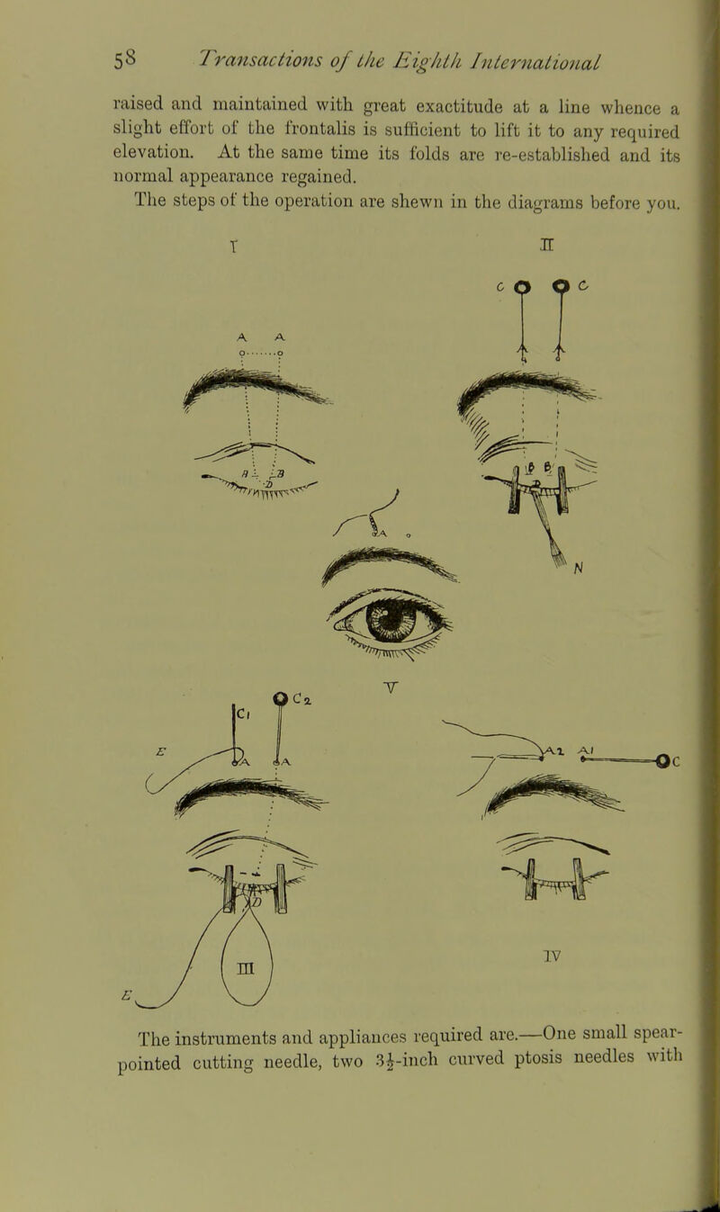 raised and maintained with great exactitude at a line whence a slight effort of the frontalis is sufftcient to lift it to any required elevation. At the same time its folds are re-established and its normal appearance regained. The steps of the operation are shewn in the diagrams before you. T H CO P ^ A A The instruments and appliances required are.—One small spear- pointed cutting needle, two 3^-inch curved ptosis needles with