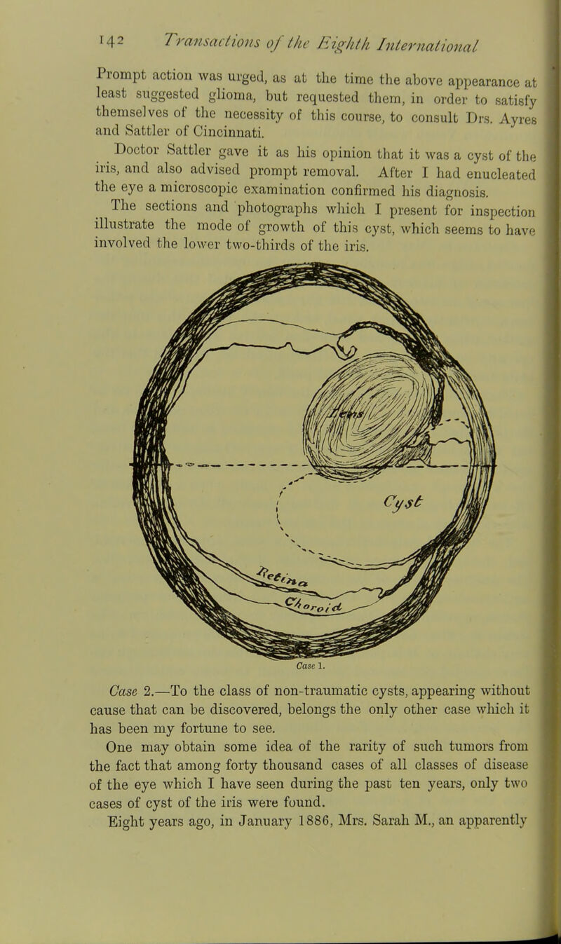 Prompt action was urged, as at the time the above appearance at least suggested glioma, but requested them, in order to satisfy themselves of the necessity of this course, to consult Drs. Ayres and Sattler of Cincinnati. Doctor Sattler gave it as his opinion that it was a cyst of the iris, and also advised prompt removal. After I had enucleated the eye a microscopic examination confirmed his diagnosis. The sections and photographs wliich I present for inspection illustrate the mode of growth of this cyst, which seems to have involved the lower two-thirds of the iris. Casa 1. Case, 2.—To the class of non-traumatic cysts, appearing without cause that can be discovered, belongs the only other case which it has been my fortune to see. One may obtain some idea of the rarity of such tumors from the fact that among forty thousand cases of all classes of disease of the eye which I have seen during the past ten years, only two cases of cyst of the iris were found. Eight years ago, in January 1886, Mrs. Sarah M., an apparently