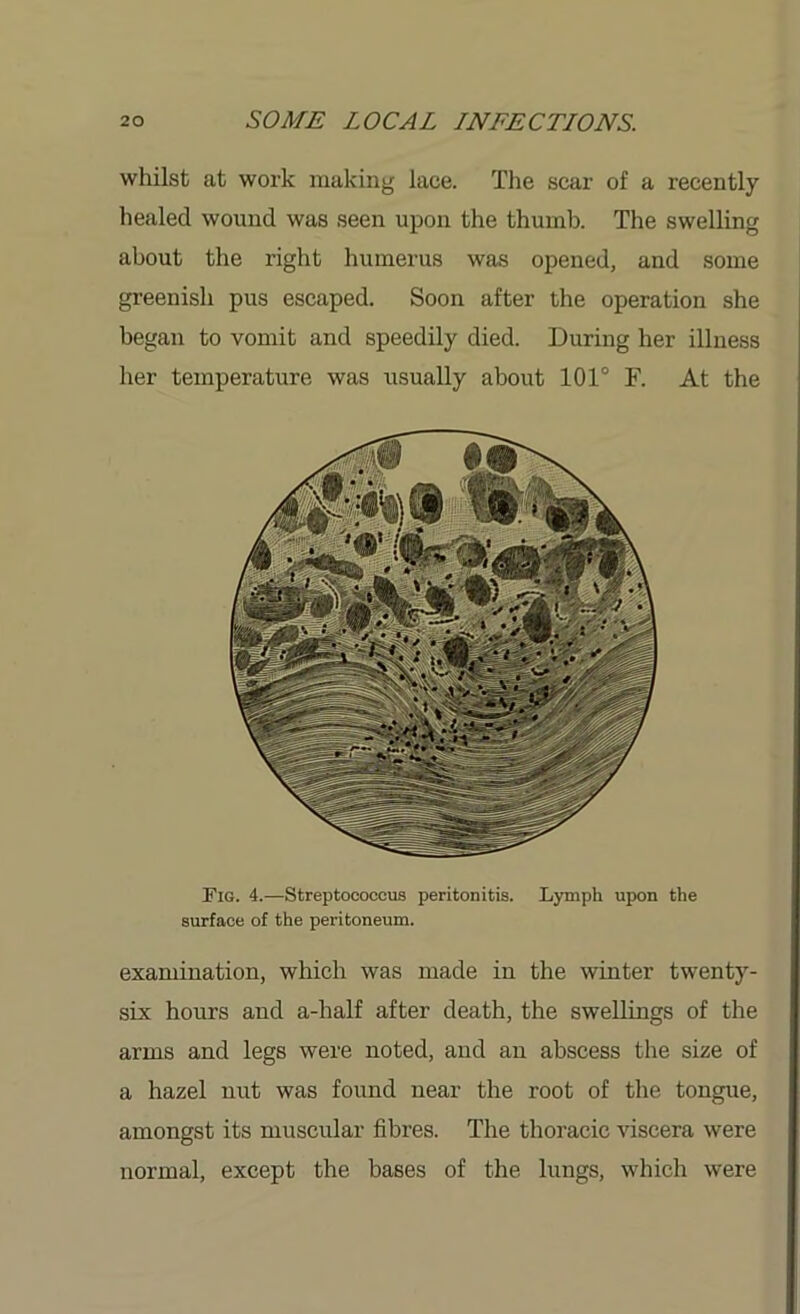 whilst at work making lace. The scar of a recently healed wound was seen upon the thumb. The swelling about the right humerus was opened, and some greenish pus escaped. Soon after the operation she began to vomit and speedily died. During her illness her temperature was usually about 101° F. At the Fig. 4.—Streptococcus peritonitis. Lymph upon the surface of the peritoneum. examination, which was made in the winter twenty- six hours and a-half after death, the swellings of the arms and legs were noted, and an abscess the size of a hazel nut was found near the root of the tongue, amongst its muscular fibres. The thoracic viscera were normal, except the bases of the lungs, which were