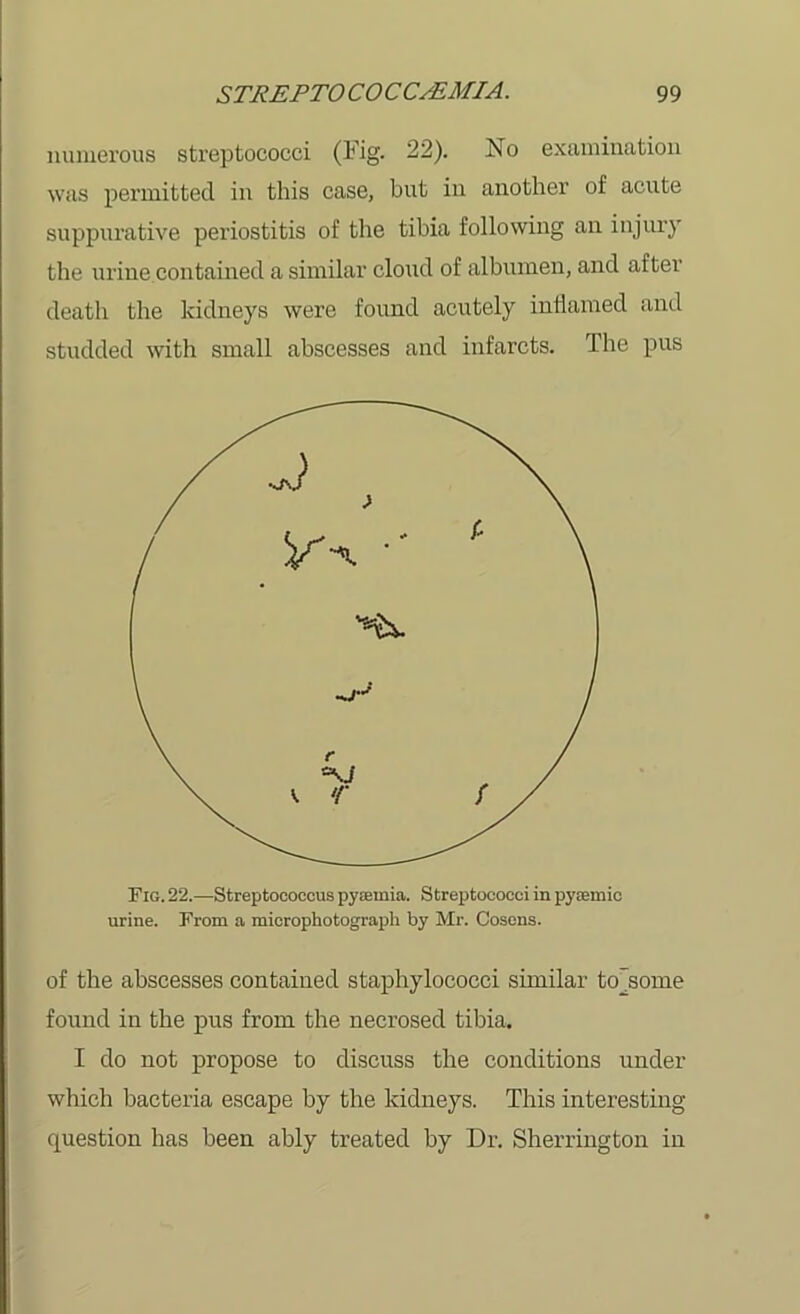 numerous streptococci (Fig. 22). No examination was permitted in this case, but in another of acute suppurative periostitis of the tibia following an injury the urine contained a similar cloud of albumen, and after death the kidneys were found acutely inflamed and studded with small abscesses and infarcts. The pus Fig. 22.—Streptococcus pysemia. Streptococci in pyiemic urine. From a microphotograph by Mr. Cosens. of the abscesses contained staphylococci similar to'some found in the pus from the necrosed tibia. I do not propose to discuss the conditions under which bacteria escape by the kidneys. This interesting- question has been ably treated by Dr. Sherrington in