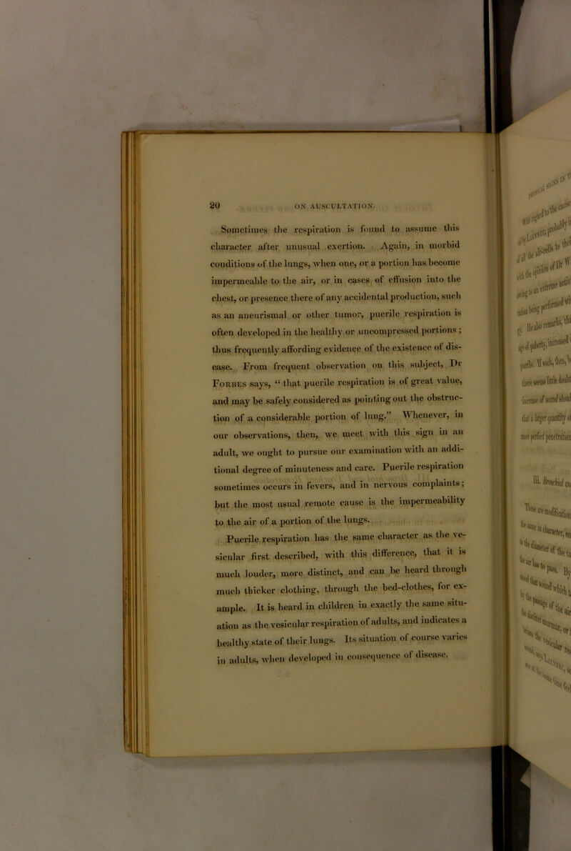 Sometimes tlie I’esplratioii is found to assume this character after unusual exertion. Again, in morbid conditions of the lungs, when one, or a portion has become impermeable to the air, or in cases of effusion into the cliest, or presence there of any accidental production, sucli as an aneurismal or otlier tumor, puerile respiration is often deA'^eloped in the healthy or uncompressed portions ; thus frequently affording evideuee of the existence of dis- ease. From frequent observation on this subject. Dr Forbes says, “ that puerile respiration is of great value, and lofty be safely considered as pointing opt the obstruc- tion of a considerable portion of lung.” Whenever, in our observations, then, we meet with this sign in an adult, we ought to pursue our examination with an addi- tional degree of minuteness and care. Puerile respiration sometimes occurs in fevers, and in nervous complaints; but the most usual remote cause is the impermeability to the air of a portion of the lungs. Puerile respiration has the same character as the ve- sicular first described, with this difference, that it is much louder, more distinct, and can be heard through much thicker clothing, through the bed-clothes, for ex- ample. It is heard in children in exactly the same situ- ation as the vesicular respiration of adults, and indicates a healthy state of their lungs. Its situation of course varies in adults, when developed in consequence of disease.
