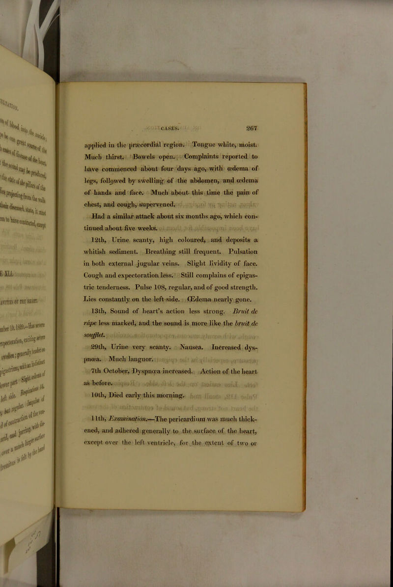 applied in Uic prsecordial region. Tongue white, moist. Much thirst. * Bowels open.:;:;'Complaints reported to have commenced about four days ago, iwith ojdema of legs, followed by swelling, of the abdomen, and oedema of hands and face. Much about, this*time the pain of chest, and cough, supeiwened. .. i' Had a similar attack about six months ago, which con- tinued about five weeks. .i/, 12th, Urine scanty, high colom’ed, and deposits a whitish sediment. Breathing still frequent. Pulsation in both external jugular veins. Slight lividity of face. Cough and expectoration less. Still complains of epigas- tric tenderness. Pulse 108, regular, and of good strength. Lies constantly on the left side. CEdema neai’ly gone. 13th, Sound of heart’s action less strong. Bruit de rape less marked, and the sound is more like the bruit de smfflet. , 29th, Urine very scanty. Nausea. Increased dys- pnoea. Much languor, , -f* ■ i—i 7th Octobei', Dyspnoea increased. Action of the lieart as before. 10th, Died early this morning. r . . . : - ■ ,  if* 1 Itli, Examination.—The pericardium Avas mucli thick- ened, and adhered generally to the surface of the heart, except over the left ventricle, for the extent of tAVo or