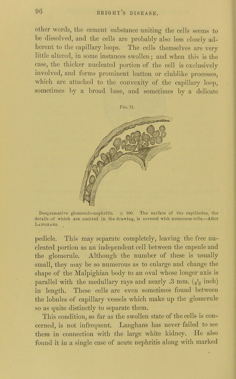 other words, the cement substance uniting the cells seems to be dissolved, and the cells are probably also less closely ad- herent to the capillary loops. The cells themselves are very little altered, in some instances swollen; and when this is the case, the thicker nucleated portion of the cell is exclusively involved, and forms prominent button or clublike processes, which are attached to the convexity of the capillary loop, sometimes by a broad base, and sometimes by a delicate Fig. 31. Desquamative glomerulonephritis. X 300. The surface of the capillaries, the details of which are omitted in the drawing, is covered with numerous cells.—After Lanuuans. pedicle. This may separate completely, leaving the free nu- cleated portion as an independent cell between the capsule and the glomerule. Although the number of these is usually small, they may be so numerous as to enlarge and change the shape of the Malpighian body to an oval whose longer axis is parallel with the medullary rays and nearly .3 mm. inch) in length. These cells are even sometimes found between the lobules of capillary vessels which make up the glomerule so as quite distinctly to separate them. This condition, so far as the swollen state of the cells is con- cerned, is not infrequent. Langhans has never failed to see them in connection with the large white kidney. He also found it in a single case of acute nephritis along with marked