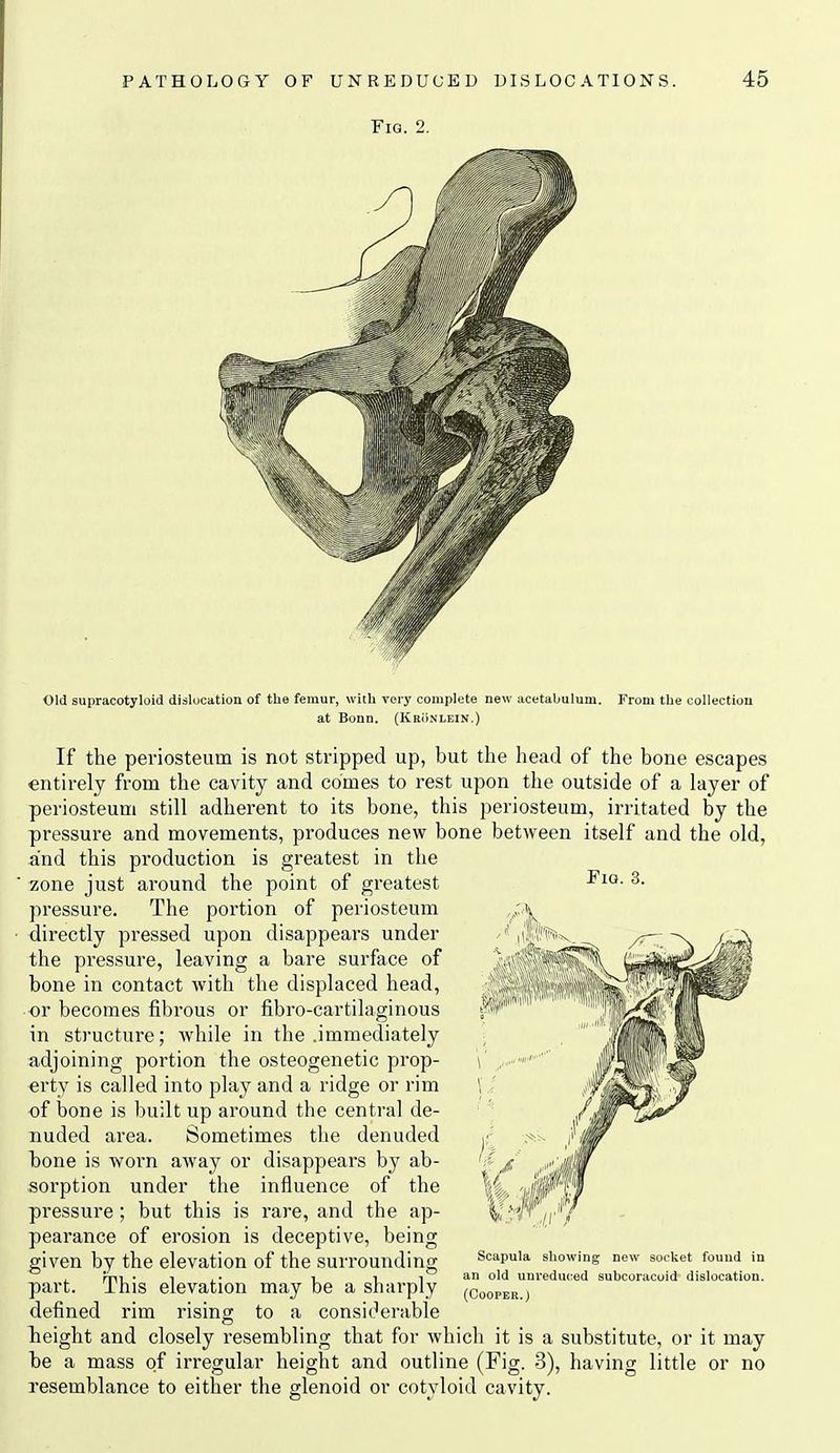 Old supracotyloid dislocation of the femur, with very complete new acetabulum. at Bonn. (KRiiNLEiN.) From the collection FiQ. 3. If the periosteum is not stripped up, but the head of the bone escapes entirely from the cavity and comes to rest upon the outside of a hiyer of periosteum still adherent to its bone, this periosteum, irritated by the pressure and movements, produces new bone between itself and the old, and this production is greatest in the zone just around the point of greatest pressure. The portion of periosteum directly pressed upon disappears under the pressure, leaving a bare surface of bone in contact with the displaced head, or becomes fibrous or fibro-cartilaginous in structure; while in the .immediately adjoining portion the osteogenetic prop- erty is called into play and a ridge or rim -of bone is built up around the central de- nuded area. Sometimes the denuded hone is worn away or disappears by ab- sorption under the influence of the pressure ; but this is rare, and the ap- pearance of ei'osion is deceptive, being given by the elevation of the surrounding part. This elevation may be a sharply defined rim rising to a considerable height and closely resembling that for which it is a substitute, or it may be a mass of irregular height and outline (Fig. 3), having little or no resemblance to either the glenoid or cotyloid cavity. Scapula showing new socket found in an old unreduced subcoracuid dislocation. (Cooper.;