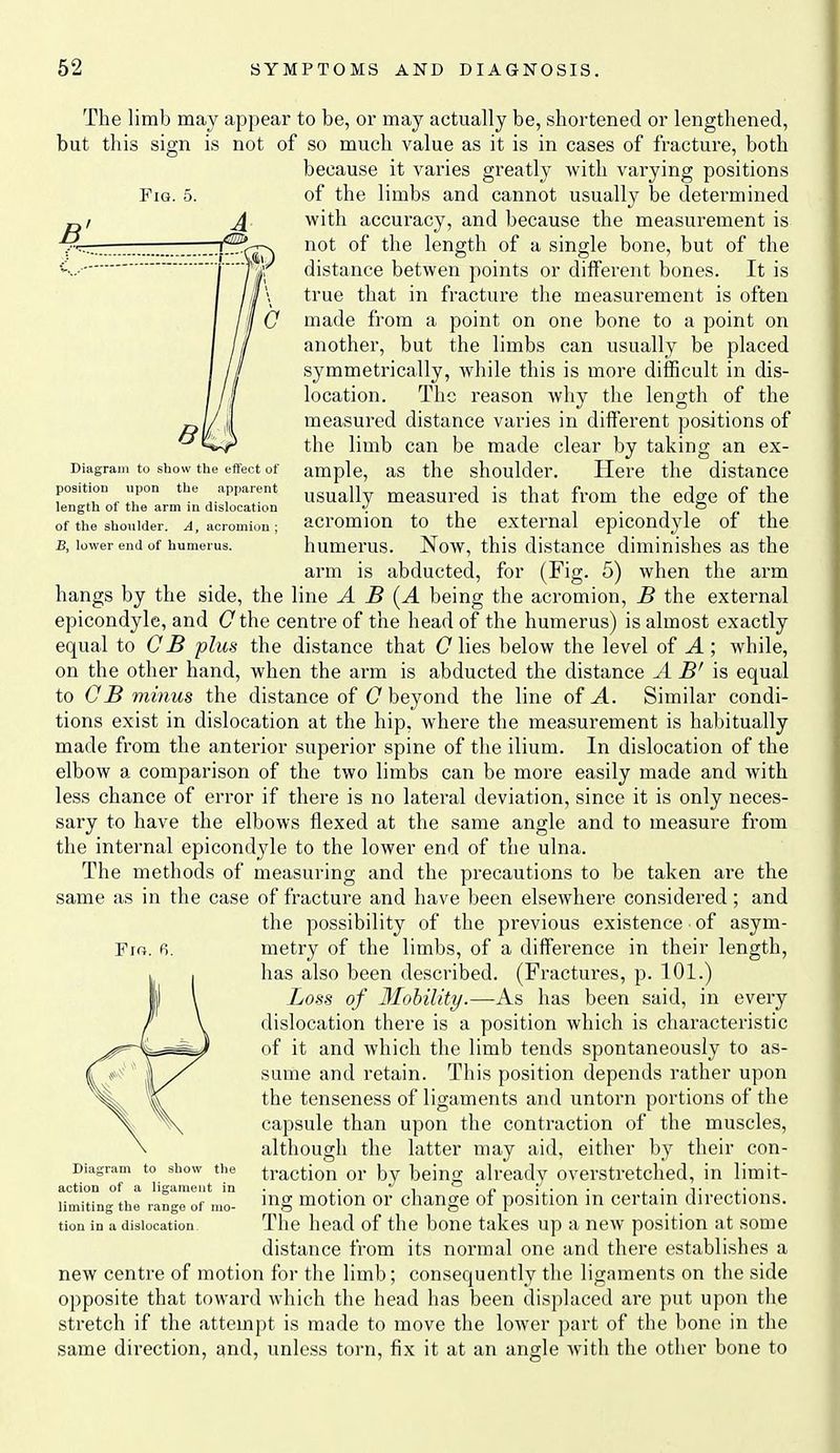 Fig. 5. Diagram to show the effect of position upon the apparent length of the arm in dislocation of the shoulder. A, acromion; B, lower end of humerus. The limb may appear to be, or may actually be, shortened or lengthened, but this sign is not of so much value as it is in cases of fracture, both because it varies greatly with varying positions of the limbs and cannot usually be determined with accuracy, and because the measurement is not of the length of a single bone, but of the distance betwen points or different bones. It is true that in fracture the measurement is often made from a point on one bone to a point on another, but the limbs can usually be placed symmetrically, while this is more difficult in dis- location. The reason why tlie length of the measured distance varies in different positions of the limb can be made clear by taking an ex- ample, as the shoulder. Here the distance usually measured is that from the edge of the acromion to the external epicondyle of the humerus. Now, this distance diminishes as the arm is abducted, for (Fig. 5) when the arm hangs by the side, the line A B [A being the acromion, B the external epicondyle, and G the centre of the head of the humerus) is almost exactly equal to CB plus the distance that C lies below the level of A ; while, on the other hand, when the arm is abducted the distance A B' is equal to CB minus the distance of (7 beyond the line of A. Similar condi- tions exist in dislocation at the hip, where the measurement is habitually made from the anterior superior spine of the ilium. In dislocation of the elbow a comparison of the two limbs can be more easily made and with less chance of error if there is no lateral deviation, since it is only neces- sary to have the elbows flexed at the same angle and to measure from the internal epicondyle to the lower end of the ulna. The methods of measuring and the precautions to be taken are the same as in the case of fracture and have been elsewhere considered; and the possibility of the previous existence of asym- metry of the limbs, of a difference in their length, has also been described. (Fractures, p. 101.) Loss of 3IohiUty.—As has been said, in every dislocation there is a position which is characteristic of it and which the limb tends spontaneously to as- sume and retain. This position depends rather upon the tenseness of ligaments and untorn portions of the capsule than upon the contraction of the muscles, although the latter may aid, either by their con- traction or by being already overstretched, in limit- ing motion or change of position in certain directions. The head of the bone takes up a new position at some distance from its normal one and there establishes a new centre of motion for the limb; consequently the ligaments on tlie side opposite that toward which the head has been displaced are put upon the stretch if the attempt is made to move the lower part of the bone in tlie same direction, gnd, unless torn, fix it at an angle with the other bone to Fro. 6. Diagram to show the action of a ligament in limiting the range of mo- tion in a dislocation.