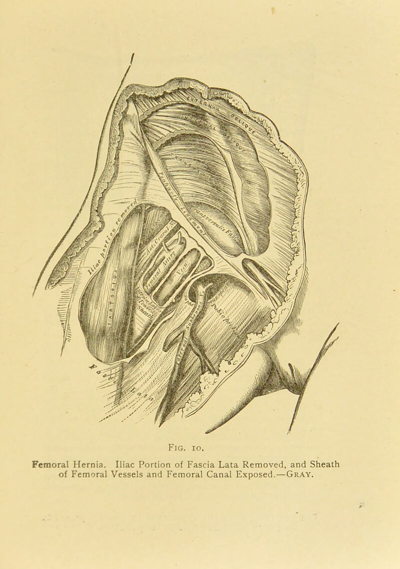 Femoral Hernia. Iliac Portion of Fascia Lata Removed, and Sheath of Femoral Vessels and Femoral Canal Exposed.—Gray.