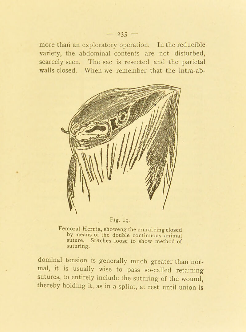 more than an exploratory operation. In the reducible variety, the abdominal contents are not disturbed, scarcely seen. The sac is resected and the parietal walls closed. When we remember that the intra-ab- Fig. 19. Femoral Hernia, shovveng the crural ring closed by means of the double continuous animal suture. Stitches loose to show method of suturing. dominal tension is generally much greater than nor- mal, it is usually wise to pass so-called retaining sutures, to entirely include the suturing of the wound, thereby holding it, as in a splint, at rest until union is