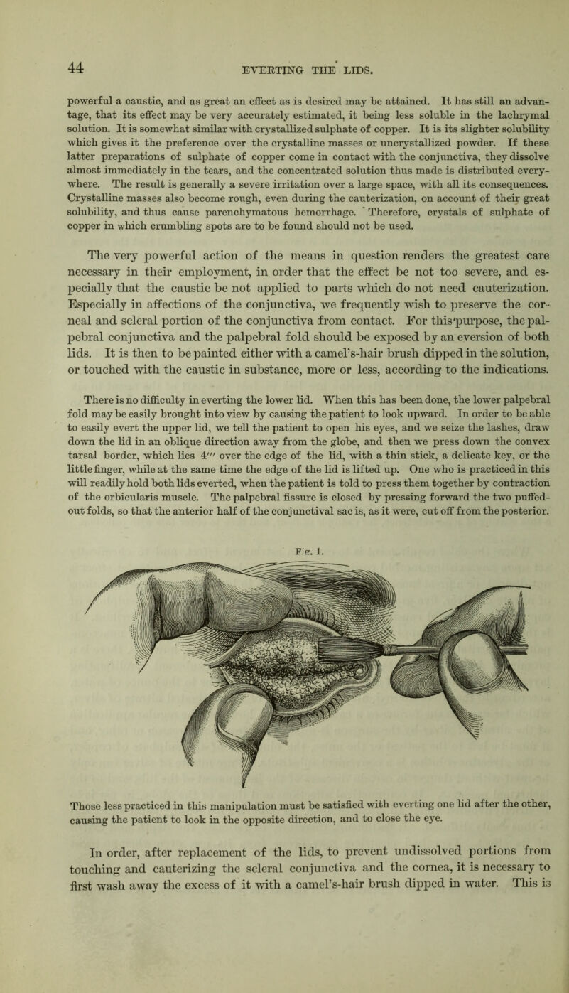powerful a caustic, and as great an effect as is desired may be attained. It has still an advan- tage, that its effect may be very accurately estimated, it being less soluble in the lachrymal solution. It is somewhat similar with crystallized sulphate of copper. It is its slighter solubility which gives it the preference over the crystalline masses or uncrystallized powder. If these latter preparations of sulphate of copper come in contact with the conjunctiva, they dissolve almost immediately in the tears, and the concentrated solution thus made is distributed every- where. The result is generally a severe irritation over a large space, with all its consequences. Crystalline masses also become rough, even during the cauterization, on account of their great solubility, and thus cause parenchymatous hemorrhage. ' Therefore, crystals of sulphate of copper in which crumbling spots are to be found should not be used. The very powerful action of the means in question renders the greatest care necessary in their employment, in order that the effect be not too severe, and es- pecially that the caustic be not applied to parts which do not need cauterization. Especially in affections of the conjunctiva, we frequently wish to preserve the cor- neal and scleral portion of the conjunctiva from contact. For this'purpose, the pal- pebral conjunctiva and the palpebral fold should be exposed by an eversion of both lids. It is then to be painted either with a camel’s-hair brush dipped in the solution, or touched with the caustic in substance, more or less, according to the indications. There is no difficulty in everting the lower lid. When this has been done, the lower palpebral fold may be easily brought into view by causing the patient to look upward. In order to be able to easily evert the upper lid, we tell the patient to open his eyes, and we seize the lashes, draw down the lid in an oblique direction away from the globe, and then we press down the convex tarsal border, which lies 4' over the edge of the lid, with a thin stick, a delicate key, or the little finger, while at the same time the edge of the lid is lifted up. One who is practiced in this will readily hold both lids everted, when the patient is told to press them together by contraction of the orbicularis muscle. The palpebral fissure is closed by pressing forward the two puffed- out folds, so that the anterior half of the conjunctival sac is, as it were, cut off from the posterior. F'er. 1. Those less practiced in this manipulation must be satisfied with everting one lid after the other, causing the patient to look in the opposite direction, and to close the eye. In order, after replacement of the lids, to prevent undissolved portions from touching and cauterizing the scleral conjunctiva and the cornea, it is necessary to first wash away the excess of it with a camel’s-hair brush dipped in water. This i3