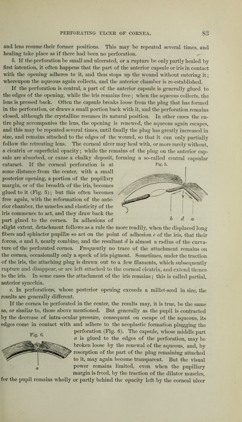 and lens resume their former positions. This may be repeated several times, and healing take place as if there had been no perforation. J). If the perforation be small and ulcerated, or a rupture be only partly healed by first intention, it often happens that the part of the anterior capsule or iris in contact with the opening adheres to it, and thus stops up the wound without entering it; whereupon the aqueous again collects, and the anterior chamber is re-established. If the perforation is central, a part of the anterior capsule is generally glued to the edges of the opening, while the iris remains free; when the aqueous collects, the lens is pressed back. Often the capsule breaks loose from the plug that has formed in the perforation, or draws a small portion back with it, and the perforation remains closed, although the crystalline resumes its natural position. In other cases the en- tire plug accompanies the lens, the opening is renewed, the aqueous again escapes, and this may be repeated several times, until finally the plug has greatly increased in size, and remains attached to the edges of the wound, so that it can only partially follow the retreating lens. The corneal ulcer may heal with, or more rarely without, a cicatrix or superficial opacity; while the remains of the plug on the anterior cap- sule are absorbed, or cause a chalky deposit, forming a so-called central capsular cataract. If the corneal perforation is at Fig. 5. some distance from the center, with a small posterior opening, a portion of the pupillary margin, or of the breadth of the iris, becomes glued to it (Fig. 5); but this often becomes free again, with the reformation of the ante- rior chamber, the muscles and elasticity of the iris commence to act, and they draw back the part glued to the cornea. In adhesions of slight extent, detachment follows as a rule the more readily, when the displaced long fibers and sphincter pupillae so act on the point of adhesion c of the iris, that their forces, a and b, nearly combine, and the resultant d is almost a radius of the curva- ture of the perforated cornea. Frequently no trace of the attachment remains on the cornea, occasionally only a speck of iris pigment. Sometimes, under the traction of the iris, the attaching plug is drawn out to a few filaments, which subsequently rupture and disappear, or are left attached to the corneal cicatrix, and extend thence to the iris. In some cases the attachment of the iris remains ; this is called partial, anterior synechia. c. In perforations, whose posterior opening exceeds a millet-seed in size, the results are generally different. If the cornea be perforated in the center, the results may, it is true, be the same as, or similar to, those above mentioned. But generally as the pupil is contracted by the decrease of intra-ocular pressure, consequent on escape of the aqueous, its edges come in contact with and adhere to the neoplastic formation plugging the perforation (Fig. 6). The capsule, whose middle part a is glued to the edges of the perforation, may be broken loose by the renewal of the aqueous, and, by resorption of the part of the plug remaining attached to it, may again become transparent. But the visual power remains limited, even when the pupillary margin is freed, by the traction of the dilator muscles, for the pupil remains wholly or partly behind the opacity left by the corneal ulcer