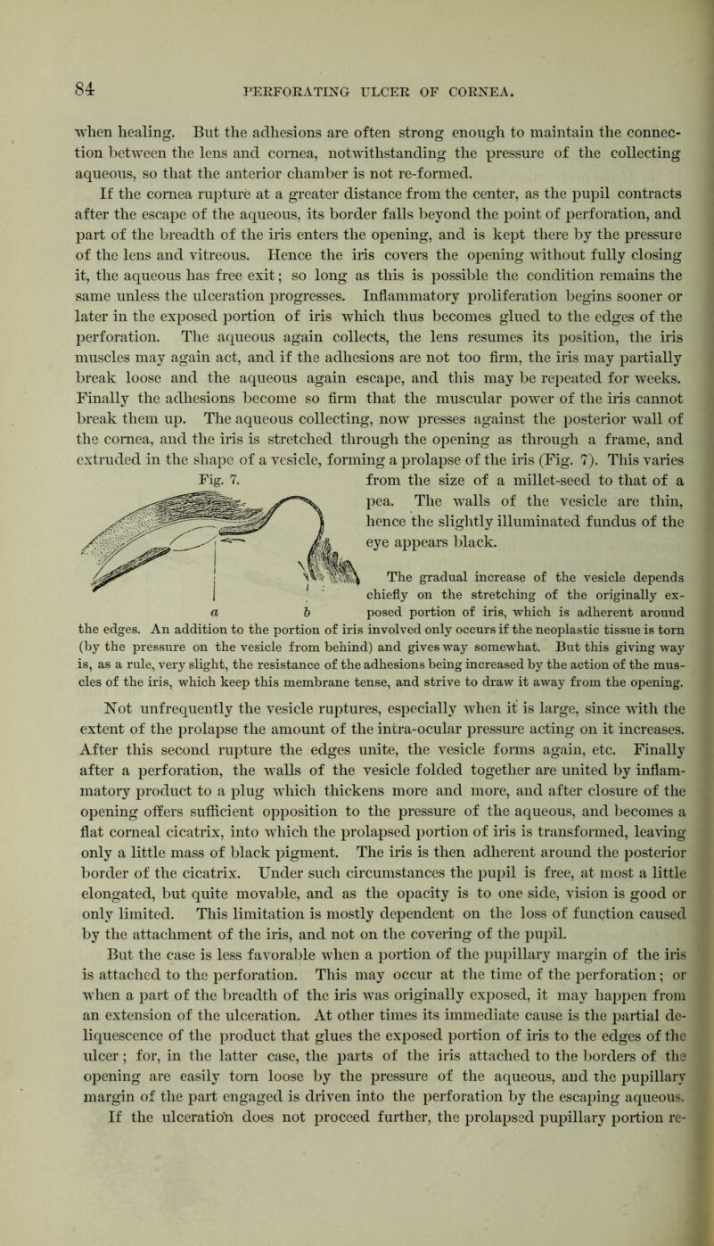when healing. But the adhesions are often strong enough to maintain the connec- tion between the lens and cornea, notwithstanding the pressure of the collecting aqueous, so that the anterior chamber is not re-formed. If the cornea rupture at a greater distance from the center, as the pupil contracts after the escape of the aqueous, its border falls beyond the point of perforation, and part of the breadth of the iris enters the opening, and is kept there by the pressure of the lens and vitreous. Hence the iris covers the opening without fully closing it, the aqueous has free exit; so long as this is possible the condition remains the same unless the ulceration progresses. Inflammatory proliferation begins sooner or later in the exposed portion of iris which thus becomes glued to the edges of the perforation. The aqueous again collects, the lens resumes its position, the iris muscles may again act, and if the adhesions are not too firm, the iris may partially break loose and the aqueous again escape, and this may be repeated for weeks. Finally the adhesions become so firm that the muscular power of the iris cannot break them up. The aqueous collecting, now presses against the posterior wall of the cornea, and the iris is stretched through the opening as through a frame, and extruded in the shape of a vesicle, forming a prolapse of the iris (Fig. 7). This varies Fig. 7. from the size of a millet-seed to that of a pea. The walls of the vesicle are thin, hence the slightly illuminated fundus of the eye appears black. The gradual increase of the vesicle depends chiefly on the stretching of the originally ex- a b posed portion of iris, which is adherent around the edges. An addition to the portion of iris involved only occurs if the neoplastic tissue is torn (by the pressure on the vesicle from behind) and gives way somewhat. But this giving way is, as a rule, very slight, the resistance of the adhesions being increased by the action of the mus- cles of the iris, which keep this membrane tense, and strive to draw it away from the opening. Not unfrequeutly the vesicle ruptures, especially when it is large, since with the extent of the prolapse the amount of the intra-ocular pressure acting on it increases. After this second rupture the edges unite, the vesicle forms again, etc. Finally after a perforation, the walls of the vesicle folded together are united by inflam- matory product to a plug which thickens more and more, and after closure of the opening offers sufficient opposition to the pressure of the aqueous, and becomes a flat corneal cicatrix, into which the prolapsed portion of iris is transformed, leaving only a little mass of black pigment. The iris is then adherent around the posterior border of the cicatrix. Under such circumstances the pupil is free, at most a little elongated, but quite movable, and as the opacity is to one side, vision is good or only limited. This limitation is mostly dependent on the loss of function caused by the attachment of the iris, and not on the covering of the pupil. But the case is less favorable when a portion of the pupillary margin of the iris is attached to the perforation. This may occur at the time of the perforation; or when a part of the breadth of the iris was originally exposed, it may happen from an extension of the ulceration. At other times its immediate cause is the partial de- liquescence of the product that glues the exposed portion of iris to the edges of the ulcer; for, in the latter case, the parts of the iris attached to the borders of the opening are easily tom loose by the pressure of the aqueous, and the pupillary margin of the part engaged is driven into the perforation by the escaping aqueous. If the ulceration does not proceed further, the prolapsed pupillary portion re-