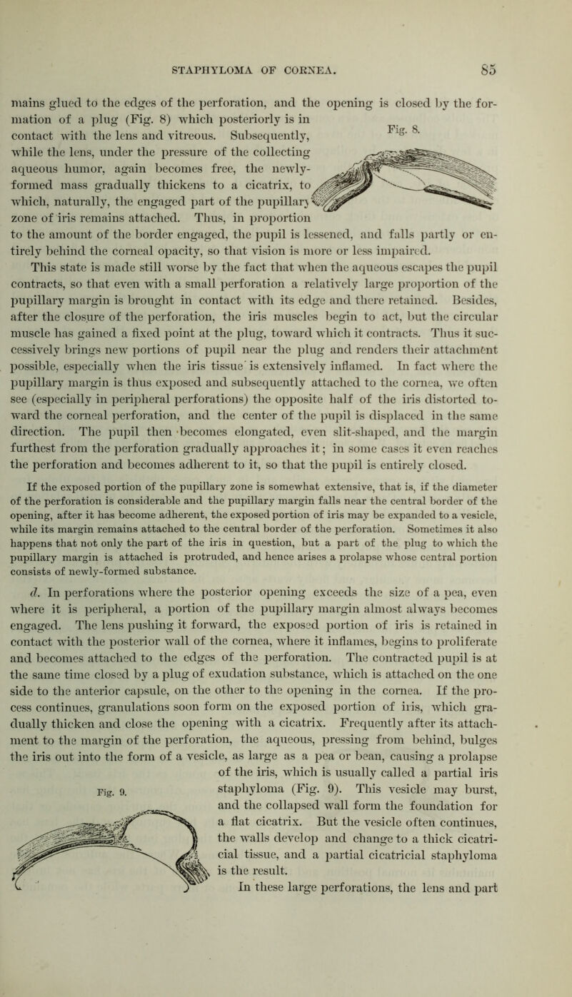 Fig. 8. mains glued to the edges of the perforation, and the opening is closed by the for- mation of a plug (Fig. 8) which posteriorly is in contact with the lens and vitreous. Subsequently, while the lens, under the pressure of the collecting aqueous humor, again becomes free, the newly- formed mass gradually thickens to a cicatrix, io which, naturally, the engaged part of the pupillary zone of iris remains attached. Thus, in proportion to the amount of the border engaged, the pupil is lessened, and falls partly or en- tirely behind the corneal opacity, so that vision is more or less impaired. This state is made still worse by the fact that when the aqueous escapes the pupil contracts, so that even with a small perforation a relatively large proportion of the pupillary margin is brought in contact with its edge and there retained. Besides, after the closure of the perforation, the iris muscles begin to act, but the circular muscle has gained a fixed point at the plug, toward which it contracts. Thus it suc- cessively brings new portions of pupil near the plug and renders their attachment possible, especially when the iris tissue' is extensively inflamed. In fact where the pupillary margin is thus exposed and subsequently attached to the cornea, we often see (especially in peripheral perforations) the opposite half of the iris distorted to- ward the corneal perforation, and the center of the pupil is displaced in the same direction. The pupil then •becomes elongated, even slit-shaped, and the margin furthest from the perforation gradually approaches it; in some cases it even reaches the perforation and becomes adherent to it, so that the pupil is entirely closed. If the exposed portion of the pupillary zone is somewhat extensive, that is, if the diameter of the perforation is considerable and the pupillary margin falls near the central border of the opening, after it has become adherent, the exposed portion of iris may be expanded to a vesicle, while its margin remains attached to the central border of the perforation. Sometimes it also happens that not only the part of the iris in question, but a part of the plug to which the pupillary margin is attached is protruded, and hence arises a prolapse whose central portion consists of newly-formed substance. d. In perforations where the posterior opening exceeds the size of a pea, even where it is peripheral, a portion of the pupillary margin almost always becomes engaged. The lens pushing it forward, the exposed portion of iris is retained in contact with the posterior wall of the cornea, where it inflames, begins to proliferate and becomes attached to the edges of the perforation. The contracted pupil is at the same time closed by a plug of exudation substance, which is attached on the one side to the anterior capsule, on the other to the opening in the cornea. If the pro- cess continues, granulations soon form on the exposed portion of iris, which gra- dually thicken and close the opening with a cicatrix. Frequently after its attach- ment to the margin of the perforation, the aqueous, pressing from behind, bulges the iris out into the form of a vesicle, as large as a pea or bean, causing a prolapse of the iris, which is usually called a partial iris staphyloma (Fig. 9). This vesicle may burst, and the collapsed wall form the foundation for a flat cicatrix. But the vesicle often continues, the walls develop and change to a thick cicatri- cial tissue, and a partial cicatricial staphyloma is the result. In these large perforations, the lens and part Fig. 9.