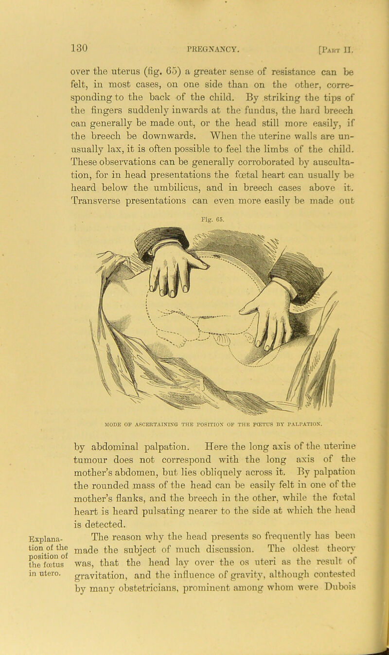 Explana- tion of the position of the foetus in utero. over the uterus (tig. 65) a greater sense of resistance can be felt, in most cases, on one side than on the other, corre- sponding to the back of the child. By striking the tips of the fingers suddenly inwards at the fundus, the hard breech can generally be made out, or the head still more easily, if the breech be downwards. When the uterine walls are un- usually lax, it is often possible to feel the limbs of the child. These observations can be generally corroborated by ausculta- tion, for in head presentations the foetal heart can usually be heard below the umbilicus, and in breech cases above it. Transverse presentations can even more easily be made out Fig. 05. MODE OP ASCERTAINING THE POSITION OP THE FCETCS BY PALPATION. by abdominal palpation. Here the long axis of the uterine tumour does not correspond with the long axis of the mother’s abdomen, but lies obliquely across it. By palpation the rounded mass of the head can be easily felt in one of the mother’s flanks, and the breech in the other, while the fcotal heart is heard pulsating nearer to the side at which the head is detected. The reason why the head presents so frequently has been made the subject of much discussion. The oldest theory was, that the head lay over the os uteri as the result of gravitation, and the influence of gravity, although contested by many obstetricians, prominent among whom were Dubois