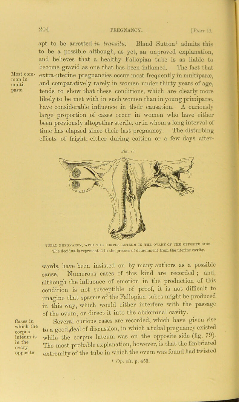 apt to be arrested in transitu. Bland Sutton1 admits this to be a possible although, as yet, an unproved explanation, and believes that a healthy Fallopian tube is as liable to become gravid as one that has been inflamed. The fact that Most com- extra-uterine pregnancies occur most frequently in multiparae, multi- arid comparatively rarely in women under thirty years of age, parte. tends to show that these conditions, which are clearly more likely to be met with in such women than in young primiparae, have considerable influence in their causation. A curiously large proportion of cases occur in women who have either been previously altogether sterile, or in whom a long interval of time has elapsed since their last pregnancy. The disturbing effects of fright, either during coition or a few days after- rig. 79. TUBAL PREGNANCY, WITH THE CORPUS LUTEUM IN THE OVAKT OE THE OPPOSITE SIDE. The decidua is represented in the process of detachment from the uterine cavity. Cases in which the corpus luteum is in the ovary opposite wards, have been insisted on by many authors as a possible cause. Numerous cases of this kind are recorded ; and. although the influence of emotion in the production of this condition is not susceptible of proof, it is not difficult to imagine that spasms of the Fallopian tubes might be produced in this way, which would either interfere with the passage of the ovum, or direct it into the abdominal cavity. Several curious cases are recorded, which have given rise to a good^deal of discussion, in which a tubal pregnancy existed while the corpus luteum was on the opposite side (fig. 70). The most probable explanation, however, is that the fimbriated extremity of the tube in which the ovum was found had twisted