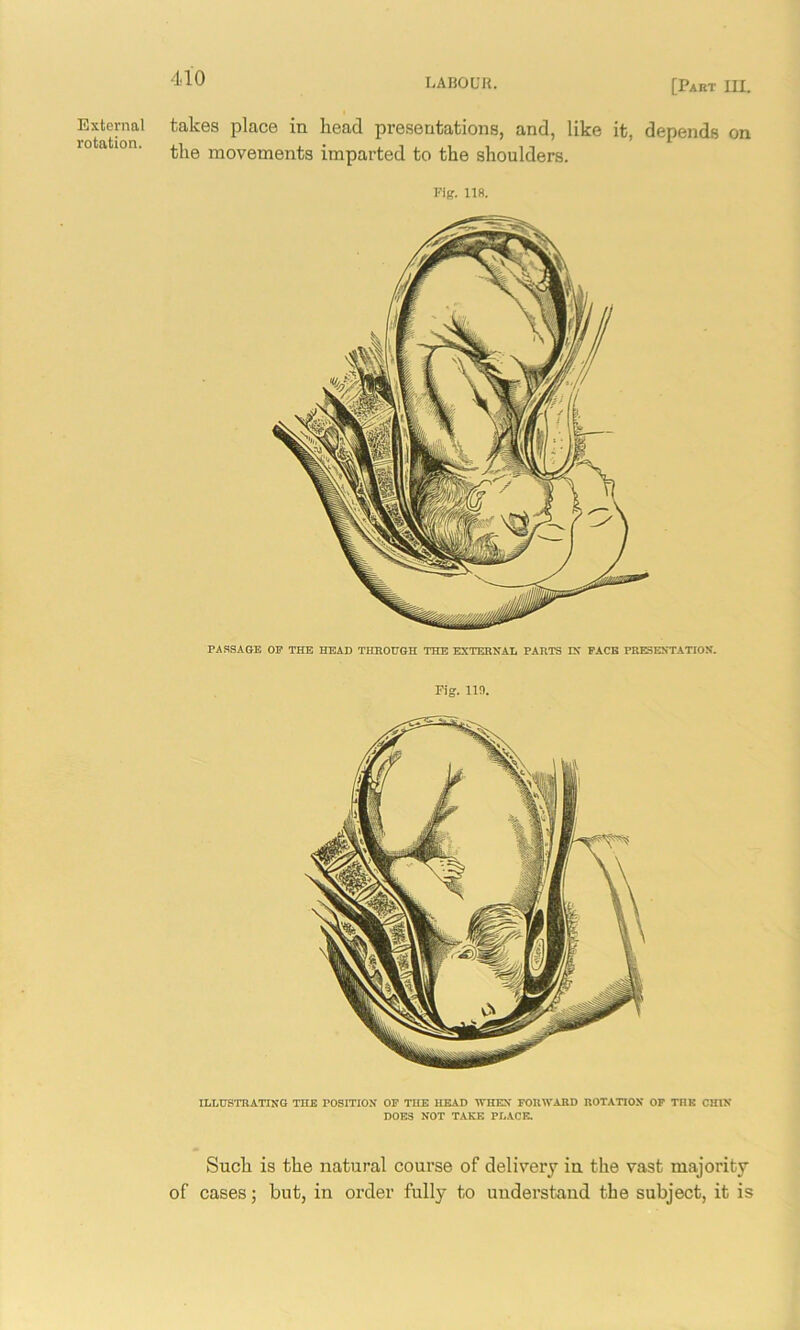 [Part III. External rotation. takes place in head presentations, and, like it, depends on the movements imparted to the shoulders. Fig. 118. PASSAGE OF THE HEAD THROUGH THE EXTERNAL PARTS IN FACE PRESENTATION. Fig. 110. ILLUSTRATING THE POSITION OF THE HEAD WHEN FORWARD ROTATION OF TRR CHIN DOES NOT TAKE PLACE. Such is the natural course of delivery in the vast majority of cases; but, in order fully to understand the subject, it is
