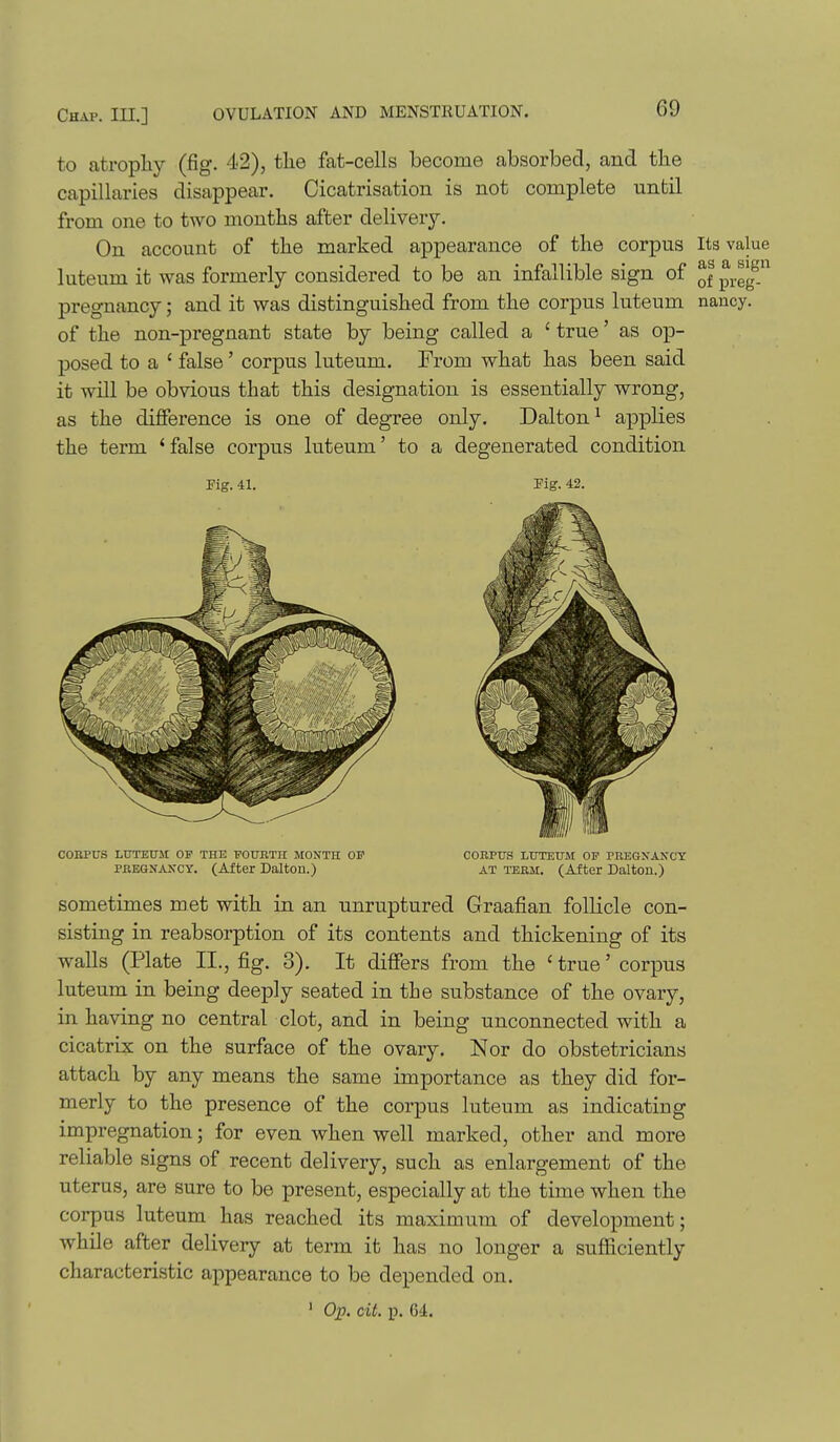 to atropliy (fig. 42), the fat-cells become absorbed, and the capillaries disappear. Cicatrisation is not complete until from one to two months after delivery. On account of the marked appearance of the corpus Its value luteum it was formerly considered to be an infallible sign of ^^.^Jf pregnancy; and it was distinguished from the corpus luteum nancy, of the non-pregnant state by being called a ' true' as op- posed to a ' false' corpus luteum. From what has been said it will be obvious that this designation is essentially wrong, as the difference is one of degree only. Dalton ^ applies the term ^ false corpus luteum' to a degenerated condition Fig. 41. Pig. 42. COBPUS LUTEUM OP THE T'OURTH MONTH OF COKPTJS LUTEUM OF PREGNANCY PREGNANCY. (After Dalton.) AT term. (After Daltou.) sometimes met with in an unruptured Graafian follicle con- sisting in reabsorption of its contents and thickening of its walls (Plate II., fig. 3). It differs from the ' true' corpus luteum in being deeply seated in the substance of the ovary, in having no central clot, and in being unconnected with a cicatrix on the surface of the ovary. Nor do obstetricians attach by any means the same importance as they did for- merly to the presence of the corpus luteum as indicating impregnation; for even when well marked, other and more reliable signs of recent delivery, such as enlargement of the uterus, are sure to be present, especially at the time when the corpus luteum has reached its maximum of development; while after deliveiy at term it has no longer a suflaciently characteristic appearance to be depended on. ' Op. cit. p. 64.