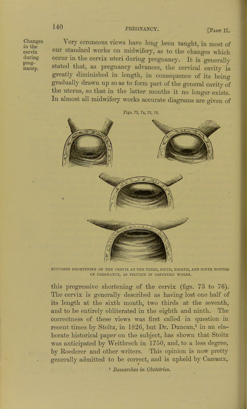 PREGNANCY. [Part II. Changes in the cervix during preg- nancy. Very erroneous views have long been taught, in most of our standard works on midwifery, as to the changes which occur in the cervix uteri during pregnancy. It is generally stated that, as pregnancy advances, the cervical cavity is greatly diminished in length, in consequence of its being gradually drawn up so as to form part of the general cavity of the uterus, so that in the latter months it no longer exists. In almost all midwifery works accurate diagrams are given of Figs. 73, 74, 75, 76. SUPPOSED SHOETBNING OF THE CEBTIX AT THE THIED, SIXTH, EIGHTH, AND NINTH MONTHS OF PKEGNANCY, AS FIGUBED IN OBSTETKIC WOBKS. this progressive shortening of the cervix (figs. 73 to 76). The cervix is generally described as having lost one half of its length at the sixth month, two thirds at the seventh, and to be entirely obliterated in the eighth and ninth. The correctness of these views was first called in question in recent times by Stoltz, in 1826, but Dr. Duncan,* in an ela- borate historical paper on the subject, has shown that Stoltz was anticipated by Weitbrech in 1750, and, to a less degree, by Roederer and other writers. This opinion is now pretty generally admitted to be correct, and is upheld by Cazeaux,