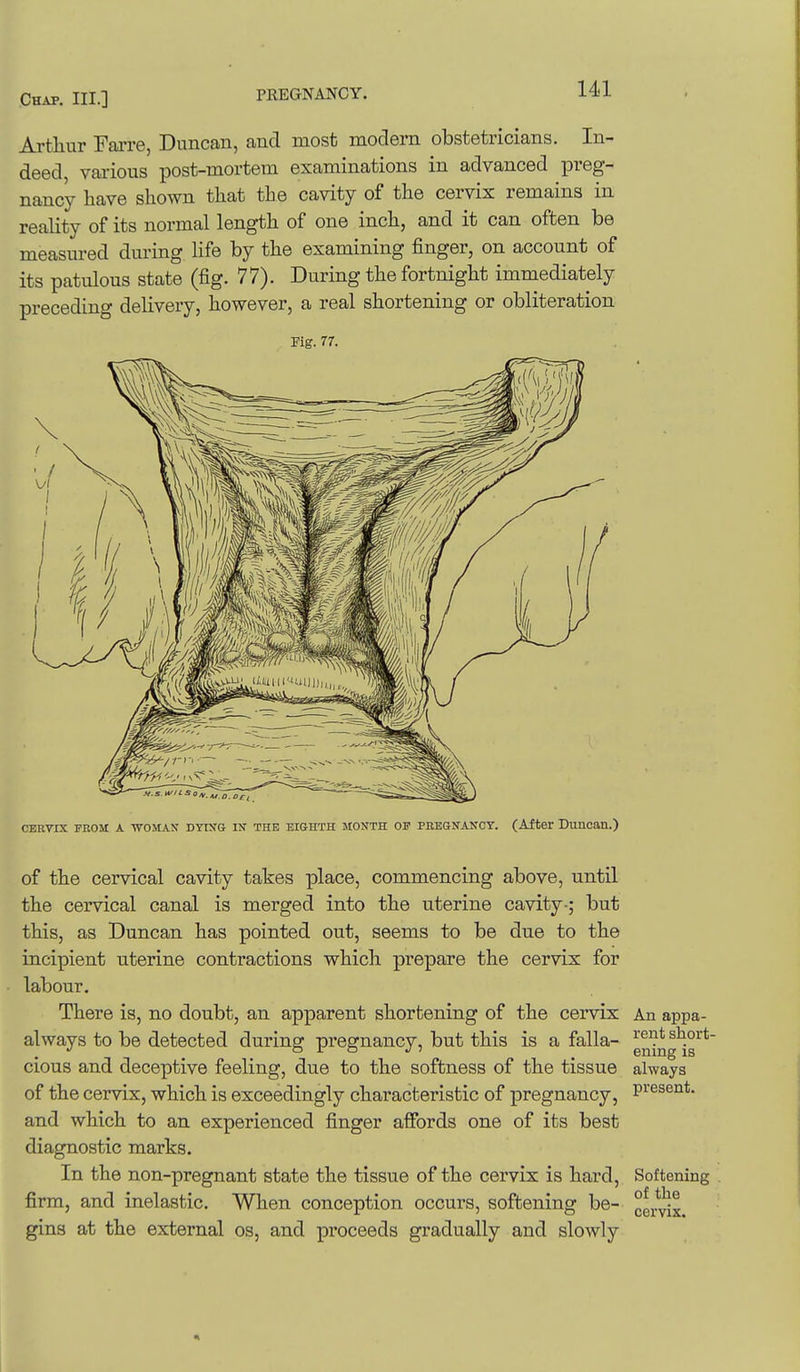 Artliiir Farre, Duncan, and most modem obstetricians. In- deed, various post-mortem examinations in advanced preg- nancy have shown that the cavity of the cervix remains in reality of its normal length of one inch, and it can often be measured during life by the examining finger, on account of its patulous state (fig. 77). During the fortnight immediately preceding delivery, however, a real shortening or obliteration Fig. 77. CERVIX PROM A -WOMAN DYtNG IN THE EIGHTH MONTH OS' PREGNANCY. (After DullcaU.) of the cervical cavity takes place, commencing above, until the cervical canal is merged into the uterine cavity-; but this, as Duncan has pointed out, seems to be due to the incipient uterine contractions which prepare the cervix for labour. There is, no doubt, an apparent shortening of the cervix always to be detected during pregnancy, but this is a falla- cious and deceptive feeling, due to the softness of the tissue of the cervix, which is exceedingly characteristic of pregnancy, and which to an experienced finger affords one of its best diagnostic marks. In the non-pregnant state the tissue of the cervix is hard, firm, and inelastic. When conception occurs, softening be- gins at the external os, and proceeds gradually and slowly An appa- rent short- ening is always present. Softening of the cervix.