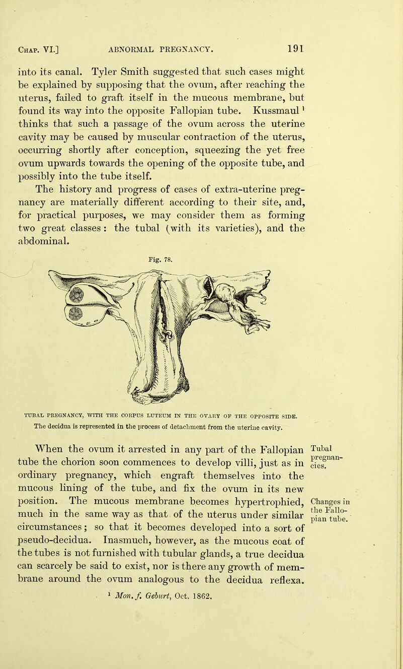 into its canal. Tyler Smith suggested that such cases might be explained by supposing that the ovum, after reaching the uterus, failed to graft itself in the mucous membrane, but found its way into the opposite Fallopian tube. Kussmaul' thinks that such a passage of the ovum across the uterine cavity may be caused by muscular contraction of the uterus, occurring shortly after conception, squeezing the yet free ovum upwards towards the opening of the opposite tube, and possibly into the tube itself. The history and progress of cases of extra-uterine preg- nancy are materially different according to their site, and, for practical purposes, we may consider them as forming two great classes: the tubal (with its varieties), and the abdominal. Pig. 78. TUBAL PREGNANCY, WITH THE CORPUS LUTEUM IN THE OVARY OP THE OPPOSITE SIDE. The decidua is represented in the process of detachment from the uterine cavity. When the ovum it arrested in any part of the Fallopian tube the chorion soon commences to develop villi, just as in ordinary pregnancy, which engraft themselves into the mucous lining of the tube, and fix the ovum in its new position. The mucous membrane becomes hypertrophied, much in the same way as that of the uterus under similar circumstances; so that it becomes developed into a sort of pseudo-decidua. Inasmuch, however, as the mucous coat of the tubes is not furnished with tubular glands, a true decidua can scarcely be said to exist, nor is there any growth of mem- brane around the ovum analogous to the decidua reflexa. Tubal pregnan- cies. Changes in the Fallo- pian tube. 1 Mon.f Geburt, Oct. 1862.