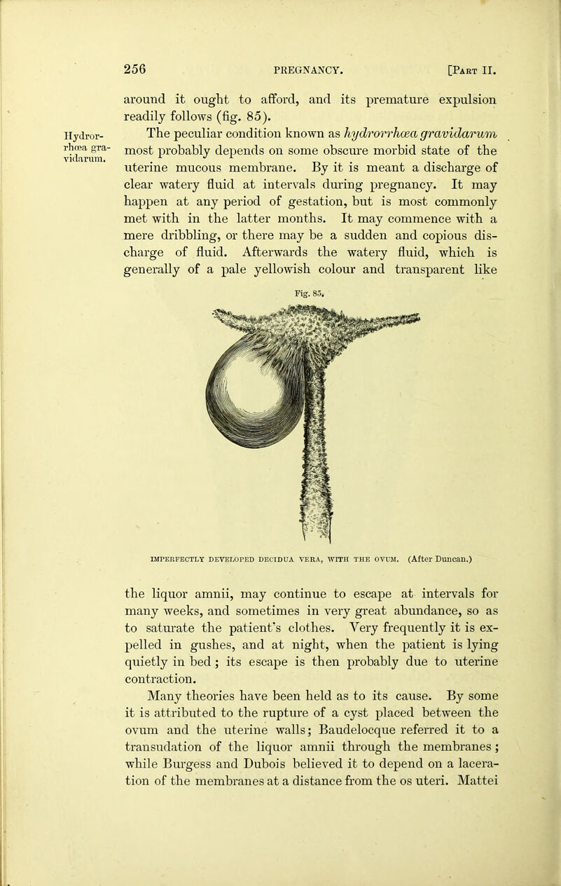 Hydror- rhrea gra- vidarum. around it ought to afford, and its premature expulsion readily follows (fig. 85). The peculiar condition known as hydrorrhoea gravidarum most probably depends on some obscure morbid state of the uterine mucous membrane. By it is meant a discharge of clear watery fluid at intervals during pregnancy. It may happen at any period of gestation, but is most commonly met with in the latter months. It may commence with a mere dribbling, or there may be a sudden and copious dis- charge of fluid. Afterwards the watery fluid, which is generally of a pale yellowish colour and transparent like Fig. 85. IMPERFECTLY DEVELOPED DECIDUA VERA, WITH THE OVUM. (After Duncail.) the liquor amnii, may continue to escape at intervals for many weeks, and sometimes in very great abundance, so as to saturate the patient's clothes. Very frequently it is ex- pelled in gushes, and at night, when the patient is lying quietly in bed; its escape is then probably due to uterine contraction. Many theories have been held as to its cause. By some it is attributed to the rupture of a cyst placed between the ovum and the uterine walls; Baudelocque referred it to a transudation of the liquor amnii through the membranes; while Burgess and Dubois believed it to depend on a lacera- tion of the membranes at a distance from the os uteri. Mattei