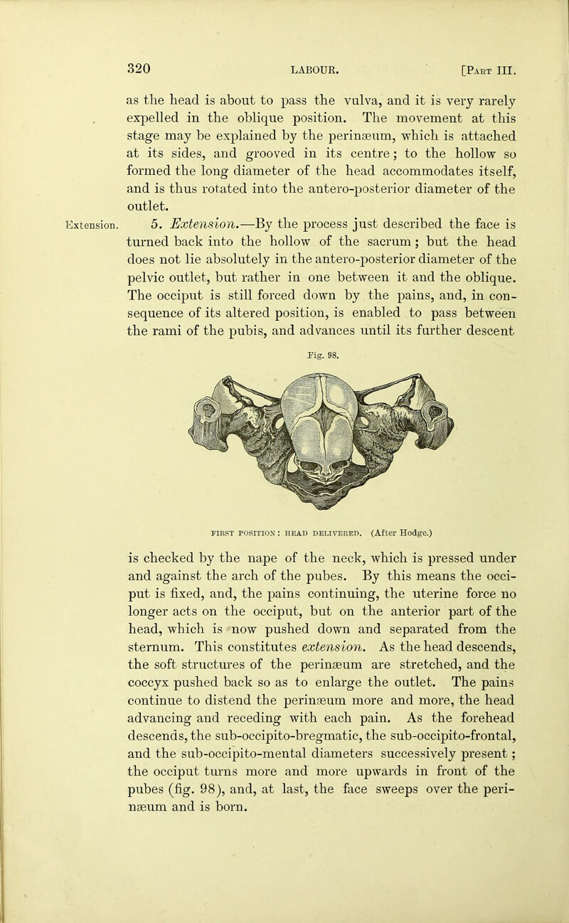 xt ension. as the head is about to pass the vulva, and it is very rarely expelled in the oblique position. The movement at this stage may be explained by the perinseum, which is attached at its sides, and grooved in its centre; to the hollow so formed the long diameter of the head accommodates itself, and is thus rotated into the antero-posterior diameter of the outlet. 5. Extension.—By the process just described the face is turned back into the hollow of the sacrum; but the head does not lie absolutely in the antero-posterior diameter of the pelvic outlet, but rather in one between it and the oblique. The occiput is still forced down by the pains, and, in con- sequence of its altered position, is enabled to pass between the rami of the pubis, and advances until its further descent Fig. 98. FIRST POSITION : HEAD delivered. (After Hodge.) is checked by the nape of the neck, which is pressed under and against the arch of the pubes. By this means the occi- put is fixed, and, the pains continuing, the uterine force no longer acts on the occiput, but on the anterior part of the head, which is now pushed down and separated from the sternum. This constitutes extension. As the head descends, the soft structures of the peringeum are stretched, and the coccyx pushed back so as to enlarge the outlet. The pains continue to distend the perinseum more and more, the head advancing and receding with each pain. As the forehead descends, the sub-occipito-bregmatic, the sub-occipito-frontal, and the sub-occipito-mental diameters successively present; the occiput turns more and more upwards in front of the pubes (fig. 98), and, at last, the face sweeps over the peri- ngeum and is born.