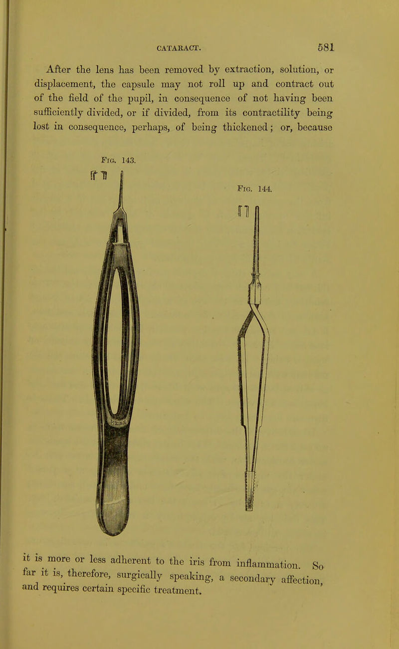 After the lens has been removed by extraction, solution, or displacement, the capsule may not roll up and contract out of the field of the pupil, in consequence of not having been sufficiently divided, or if divided, from its contractility being lost in consequence, perhaps, of being thickened; or, because Fig. 143. It is more or less adherent to the iris from inflammation. So far It IS, therefore, surgically speaking, a secondary afiection and requires certain specific treatment.