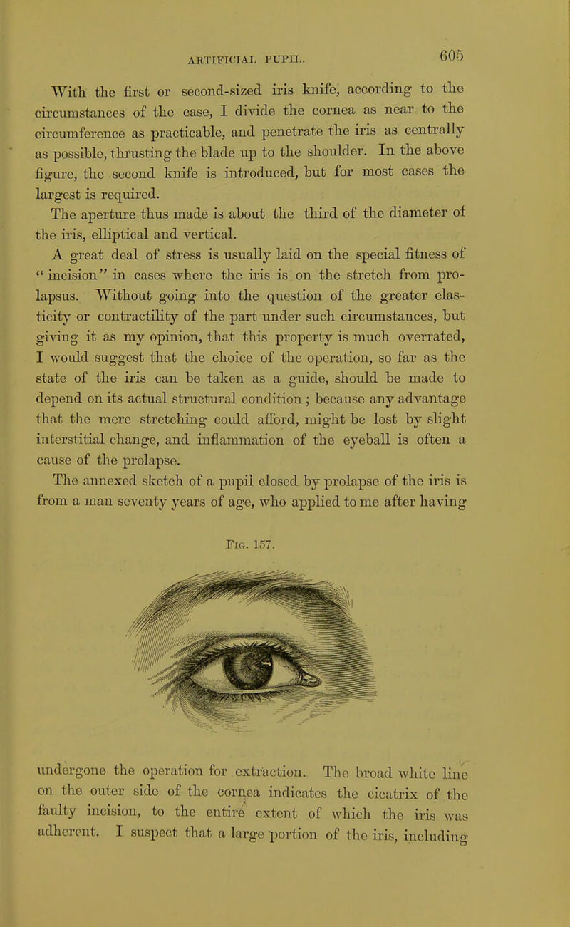 With the first or second-sized iris knife, according to the circnnistances of the case, I divide the cornea as near to the circumference as practicable, and penetrate the iris as centrally as possible, thrusting the blade up to the shoulder. In the above figure, the second knife is introduced, but for most cases the largest is required. The aperture thus made is about the third of the diameter of the iris, elliptical and vertical. A great deal of stress is usually laid on the special fitness of “ incision” in cases where the iris is on the stretch from pro- lapsus. Without going into the question of the greater elas- ticity or contractility of the part under such circumstances, but giving it as my opinion, that this property is much overrated, I woidd suggest that the choice of the operation, so far as the state of the iris can be taken as a guide, should be made to depend on its actual structural condition; because any advantage that the mere stretching could afford, might be lost by slight interstitial change, and inflammation of the eyeball is often a cause of the prolapse. The annexed sketch of a pupil closed by prolapse of the iris is from a man seventy years of age, who applied tome after having Fig. 157. undergone the operation for extraction. The broad white liiio on the outer side of the cornea indicates the cicatrix of the faulty incision, to the entire extent of which the iris was adherent. I suspect that a large portion of the iris, including