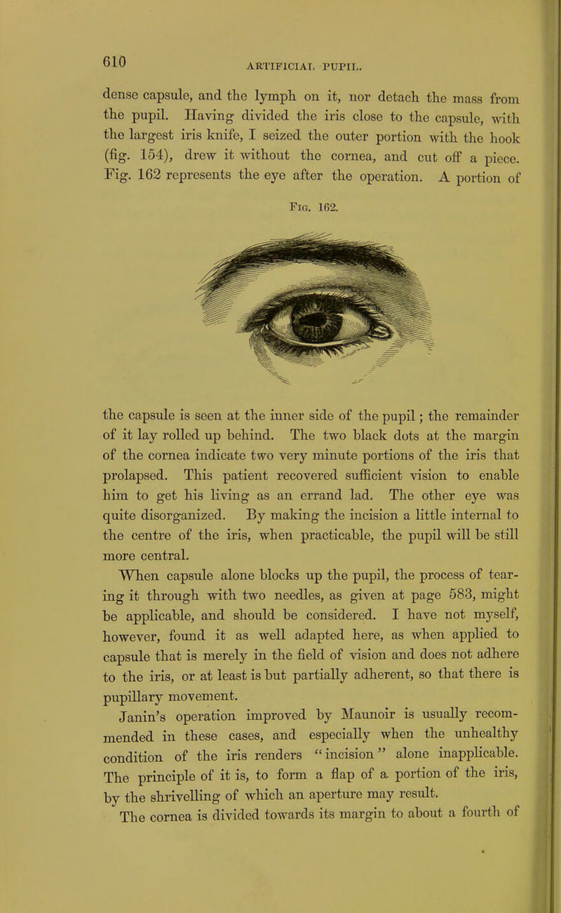 ARTIFICIAI, rum,. dense capsule, and the lymph on it, nor detach the mass from the pupil. Having divided the iris close to the capsule, with the largest iris knife, I seized the outer portion with the hook (fig. 154), drew it without the cornea, and cut off a piece. Fig. 162 represents the eye after the operation. A portion of Fig. 162. the capsule is seen at the inner side of the pupil; the remainder of it lay rolled up behind. The two black dots at the margin of the cornea indicate two very minute portions of the iris that prolapsed. This patient recovered sufficient vision to enable him to get his living as an errand lad. The other eye was quite disorganized. By making the incision a little internal to the centre of the iris, when practicable, the pupil will be still more central. When capsule alone blocks up the pupil, the process of tear- ing it through with two needles, as given at page 583, might be applicable, and should be considered. I have not myself, however, found it as well adapted here, as when applied to capsule that is merely in the field of vision and does not adhere to the iris, or at least is but partially adherent, so that there is pupillary movement. Janin’s operation improved by Maunoir is usually recom- mended in these cases, and especially when the unhealthy condition of the iris renders “incision” alone inapplicable. The principle of it is, to form a flap of a portion of the iris, by the shrivelling of which an aperture may result. The cornea is divided towards its margin to about a fourth of