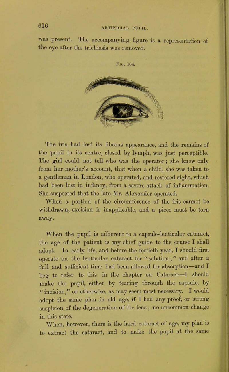 ARTIFICIAL PUPIL. was present. The accompanying figure is a representation of the eye after the trichiasis was removed. Fig. 164, The iris had lost its fibrous appearance, and the remains of the pupil in its centre, closed by lymph, was just perceptible. The girl could not tell who was the operator; she knew only from her mother’s account, that when a child, she was taken to a gentleman in London, who operated, and restored sight, which had been lost in infancy, from a severe attack of inflammation. She suspected that the late Mr. Alexander operated. When a portion of the circumference of the iris cannot be withdrawn, excision is inapplicable, and a piece must be torn away. When the pupil is adherent to a capsulo-lenticular cataract, the age of the patient is my chief guide to the course I shall adopt. In early life, and before the fortieth year, I should first operate on the lenticular cataract for “ solution; ” and after a full and sufficient time had been allowed for absorption—and I beg to refer to this in the chapter on Cataract—I shoidd make the pupil, either by tearing through the capsule, by “ incision,” or otherwise, as may seem most necessary. I would adopt the same plan in old age, if I had any proof, or strong suspicion of the degeneration of the lens ; no uncommon change in this state. When, however, there is the hard cataract of age, my plan is to extract the cataract, and to make the pupil at the same