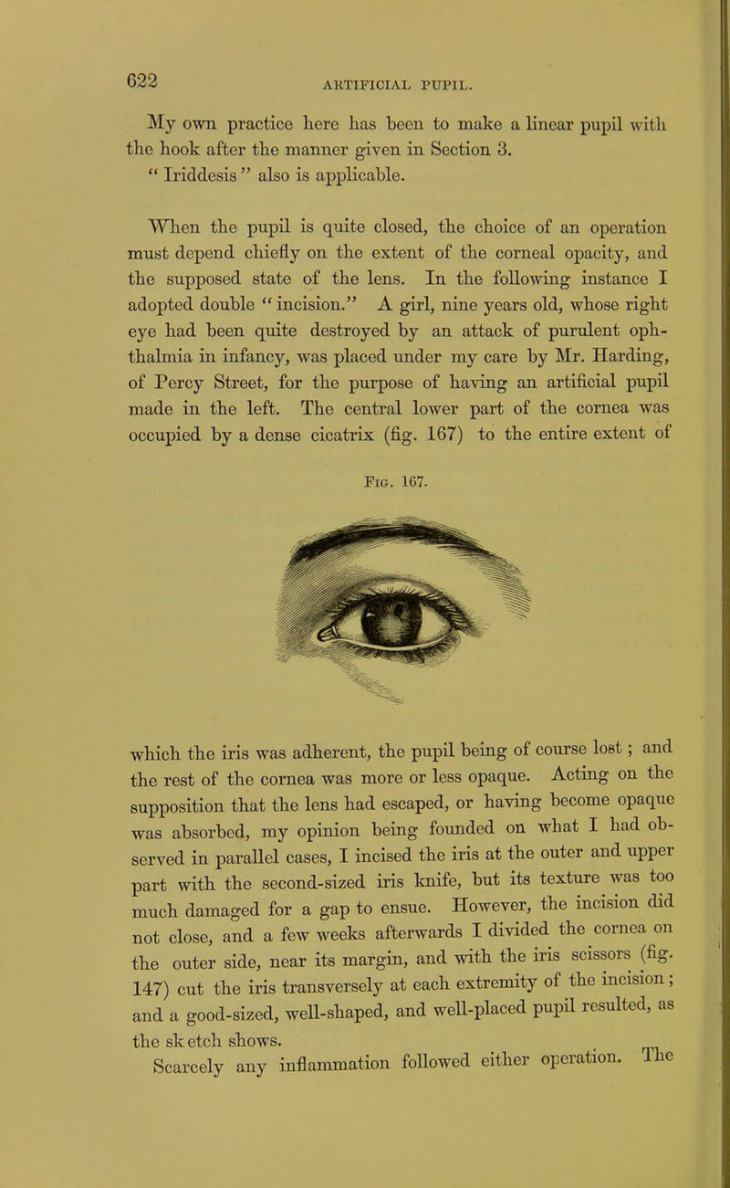 My own practice liere has been to make a linear pupil with the hook after the manner given in Section 3. “ Iriddesis ” also is applicable. When the pupil is quite closed, the choice of an operation must depend chiefly on the extent of the corneal opacity, and the supposed state of the lens. In the following instance I adopted double “ incision.” A girl, nine years old, whose right eye had been quite destroyed by an attack of purulent oph- thalmia in infancy, was placed under my care by Mr. Hardiug, of Percy Street, for the purpose of having an artificial pupil made in the left. The central lower part of the cornea was occupied by a dense cicatrix (fig. 167) to the entire extent of Fig. 167. which the iris was adherent, the pupil being of course lost; and the rest of the cornea was more or less opaque. Acting on the supposition that the lens had escaped, or having become opaque was absorbed, my opinion being founded on what I had ob- served in parallel cases, I incised the iris at the outer and upper part with the second-sized iris knife, but its texture was too much damaged for a gap to ensue. However, the incision did not close, and a few weeks afterwards I divided the cornea on the outer side, near its margin, and with the iris scissors (fig. 147) cut the iris transversely at each extremity of the incision, and a good-sized, well-shaped, and well-placed pupil resulted, as the sketch shows. Scarcely any inflammation followed either operation. The