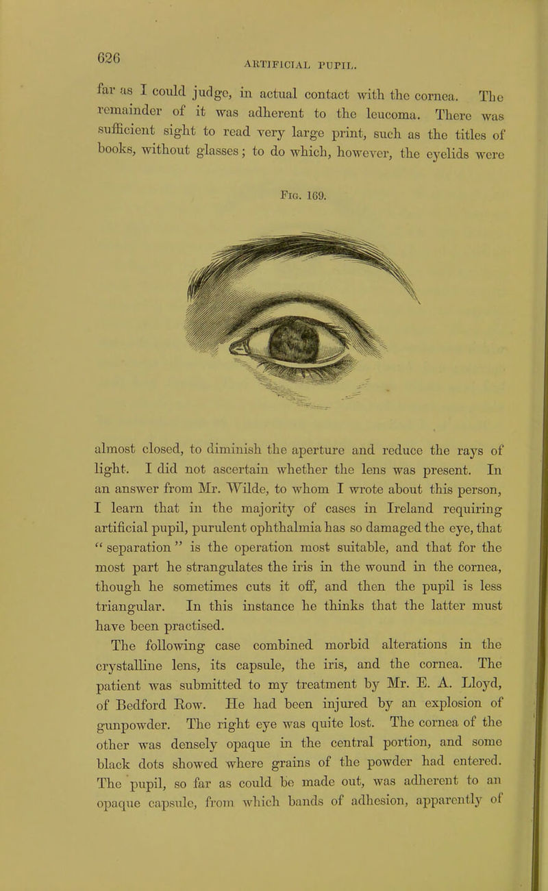 artificial ruriL. far us I could judge, in actual contact with the cornea. The remainder of it was adherent to the leucoma. There was sufficient sight to read very large print, such as the titles of books, without glasses; to do which, however, the eyelids were Fig. 169. almost closed, to diminish the aperture and reduce the rays of light. I did not ascertain whether the lens was present. In an answer from Mr. Wilde, to whom I wrote about this person, I learn that in the majority of cases in Ireland requiring artificial pupil, purulent ophthalmia has so damaged the eye, that “ separation ” is the operation most suitable, and that for the most part he strangulates the iris in the wound in the cornea, though he sometimes cuts it off, and then the pupil is less triangular. In this instance he thinks that the latter must have been practised. The following case combined morbid alterations in the crystalline lens, its capsule, the iris, and the cornea. The patient was submitted to my treatment by Mr. E. A. Lloyd, of Bedford Eow. He had been injured by an explosion of gunpowder. The right eye was quite lost. The cornea of the other was densely opaque in the central portion, and some black dots showed where grains of the powder had entered. The pupil, so far as could be made out, was adherent to an opaque cap.sule, from which bands of adlicsion, apparently of