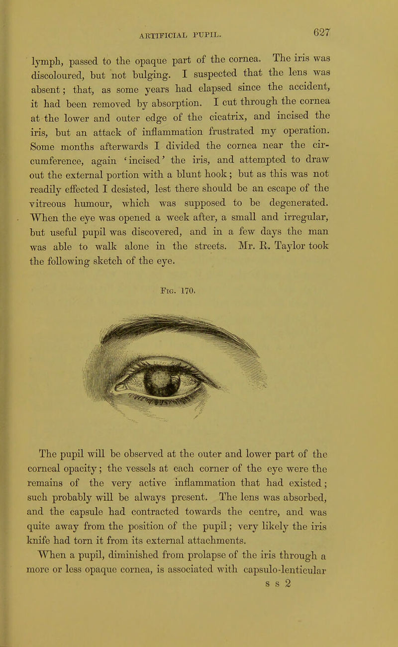 tympli, passed to the opaque part of the cornea. The iris was discoloured, but not bidging. I suspected that the lens was absent; that, as some years had elapsed since the accident, it had been removed by absorption. I cut through the cornea at the lower and outer edge of the cicatrix, and incised the iris, but an attack of inflammation frustrated my operation. Some months afterwards I divided the cornea near the cir- cumference, again ‘incised’ the iris, and attempted to draw out the external portion with a blunt hook; but as this was not readily effected I desisted, lest there should be an escape of the vitreous humour, which was supposed to be degenerated. When the eye was opened a week after, a small and irregular, but useful pupfl, was discovered, and in a few days the man was able to walk alone in the streets. Mr. R. Taylor took the following sketch of the eye. Fig. 170. The pupil will be observed at the outer and lower part of the corneal opacity; the vessels at each corner of the eye were the remains of the very active inflammation that had existed; such probably will be always present. The lens was absorbed, and the capsule had contracted towards the centre, and was quite away from the position of the pupil; very likely the iris knife had torn it from its external attaehments. When a pupil, diminished from prolapse of the iris through a more or less opaque cornea, is associated with capsulo-lenticular s s 2