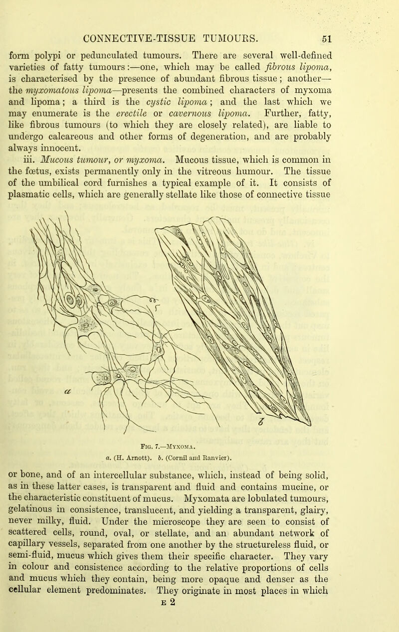 form polypi or pedunculated tumours. There are several well-defined varieties of fatty tumours:—one, which may be called fibrous lipoma, is characterised by the presence of abundant fibrous tissue ; another— the myxomatous lipoma—presents the combined characters of myxoma and lipoma; a third is the cystic lipoma; and the last which we may enumerate is the erectile or cavernous lipoma. Further, fatty, like fibrous tumours (to which they are closely related), are liable to undergo calcareous and other forms of degeneration, and are probably always innocent. iii. Mucous tumour, or myxoma. Mucous tissue, which is common in the foetus, exists permanently only in the vitreous humour. The tissue of the umbilical cord furnishes a typical example of it. It consists of plasmatic cells, which are generally stellate like those of connective tissue Fig. 7.—Myxoma. a. (H. Arnott). 6. (Cornil and Ranvier). or bone, and of an intercellular substance, which, instead of being solid, as in these latter cases, is transparent and fluid and contains mucine, or the characteristic constituent of mucus. Myxomata are lobulated tumours, gelatinous in consistence, translucent, and yielding a transparent, glairy, never milky, fluid. Under the microscope they are seen to consist of scattered cells, round, oval, or stellate, and an abundant network of capillary vessels, separated from one another by the structureless fluid, or semi-fluid, mucus which gives them their specific character. They vary in colour and consistence according to the relative proportions of cells and mucus which they contain, being more opaque and denser as the cellular element predominates. They originate in most places in which e 2