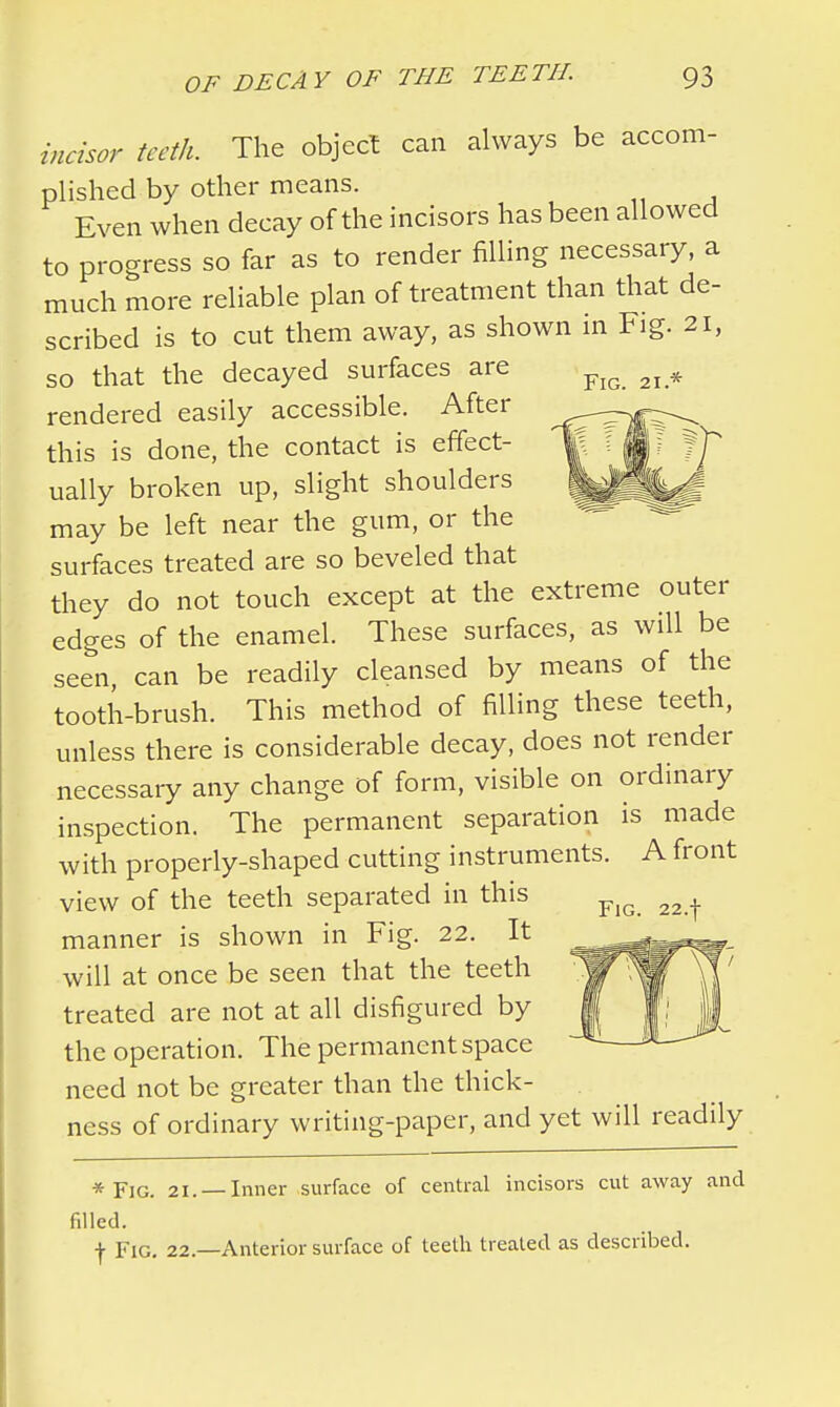 Fig. 21.* incisor teeth. The object can always be accom- plished by other means. Even when decay of the incisors has been allowed to progress so far as to render filling necessary, a much more reliable plan of treatment than that de- scribed is to cut them away, as shown in Fig. 21, so that the decayed surfaces are rendered easily accessible. After this is done, the contact is effect- ually broken up, slight shoulders may be left near the gum, or the surfaces treated are so beveled that they do not touch except at the extreme outer edges of the enamel. These surfaces, as will be seen, can be readily cleansed by means of the tooth-brush. This method of filling these teeth, unless there is considerable decay, does not render necessary any change of form, visible on ordinary inspection. The permanent separation is made with properly-shaped cutting instruments. A front view of the teeth separated in this manner is shown in Fig. 22. It will at once be seen that the teeth treated are not at all disfigured by the operation. The permanent space need not be greater than the thick- ness of ordinary writing-paper, and yet will readily * FjG. 21. Inner surface of central incisors cut away and filled. f Fig. 22.—Anterior surface of teeth treated as described. Fig. 22.f