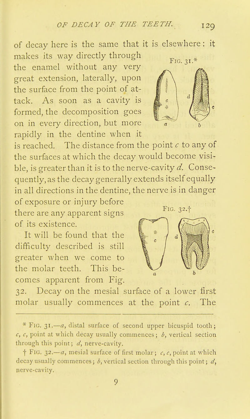 Fig. 31.* of decay here is the same that it is elsewhere: it makes its way directly through the enamel without any very great extension, laterally, upon the surface from the point of at- tack. As soon as a cavity is formed, the decomposition goes on in every direction, but more rapidly in the dentine when it is reached. The distance from the point c to any of the surfaces at which the decay would become visi- ble, is greater than it is to the nerve-cavity d. Conse- quently, as the decay generally extends itself equally in all directions in the dentine, the nerve is in danger of exposure or injury before there are any apparent signs of its existence. It will be found that the difficulty described is still greater when we come to the molar teeth. This be- comes apparent from Fig. 32. Decay on the mesial surface of a lower first molar usually commences at the point c. The Fig. 32. * Fig. 31.—a, distal surface of second upper bicuspid tooth; <r, c, point at which decay usually commences; b, vertical section through this point; d, nerve-cavity. I Fig. 32.—a, mesial surface of first molar; c, c, point at which decay usually commences; b, vertical section through this point; d, nerve-cavity. 9