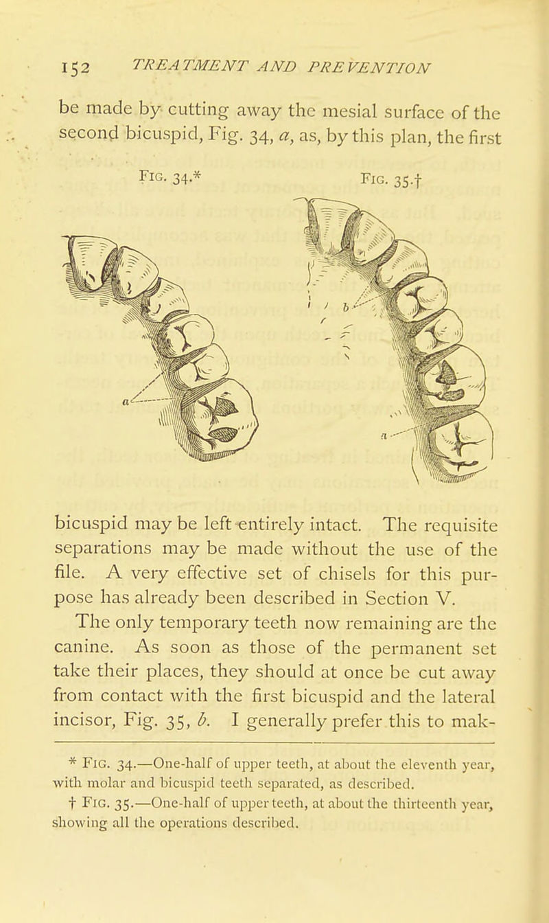 be made by cutting away the mesial surface of the second bicuspid, Fig. 34, a, as, by this plan, the first Fig. 34* Fig. 354 bicuspid may be left-entirely intact. The requisite separations may be made without the use of the file. A very effective set of chisels for this pur- pose has already been described in Section V. The only temporary teeth now remaining are the canine. As soon as those of the permanent set take their places, they should at once be cut away from contact with the first bicuspid and the lateral incisor, Fig. 35, b. I generally prefer this to mak- * Fig. 34.—One-half of upper teeth, at about the eleventh year, with molar and bicuspid teeth separated, as described. f Fig. 35.—One-half of upper teeth, at about the thirteenth year, showing all the operations described.