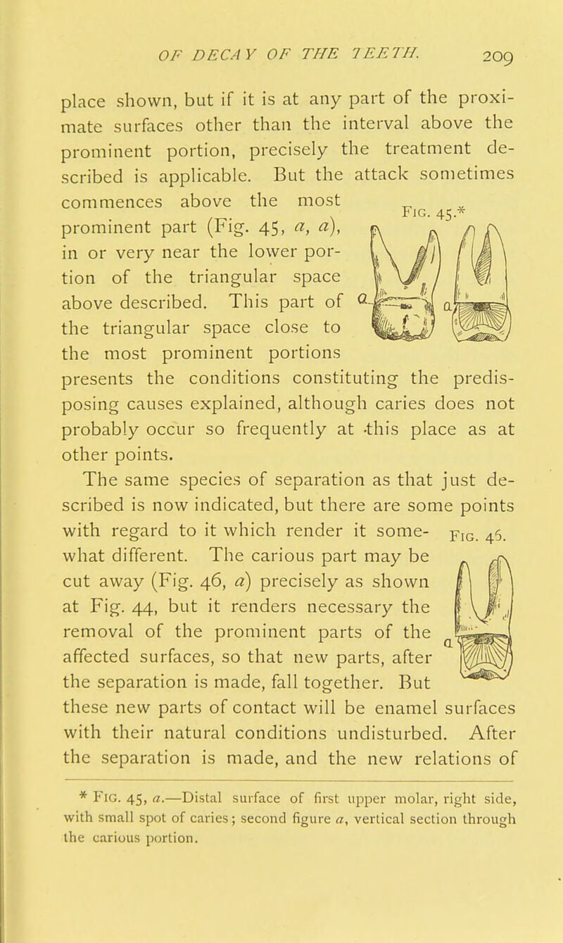 Fig. 45.* place shown, but if it is at any part of the proxi- mate surfaces other than the interval above the prominent portion, precisely the treatment de- scribed is applicable. But the attack sometimes commences above the most prominent part (Fig. 45, a, a), in or very near the lower por- tion of the triangular space above described. This part of the triangular space close to the most prominent portions presents the conditions constituting the predis- posing causes explained, although caries does not probably occur so frequently at -this place as at other points. The same species of separation as that just de- scribed is now indicated, but there are some points with regard to it which render it some- fig, 45. what different. The carious part may be cut away (Fig. 46, a) precisely as shown at Fig. 44, but it renders necessary the removal of the prominent parts of the affected surfaces, so that new parts, after the separation is made, fall together. But these new parts of contact will be enamel surfaces with their natural conditions undisturbed. After the separation is made, and the new relations of * Fig. 45, a.—Distal surface of first upper molar, right side, with small spot of caries; second figure a, vertical section through the carious portion.