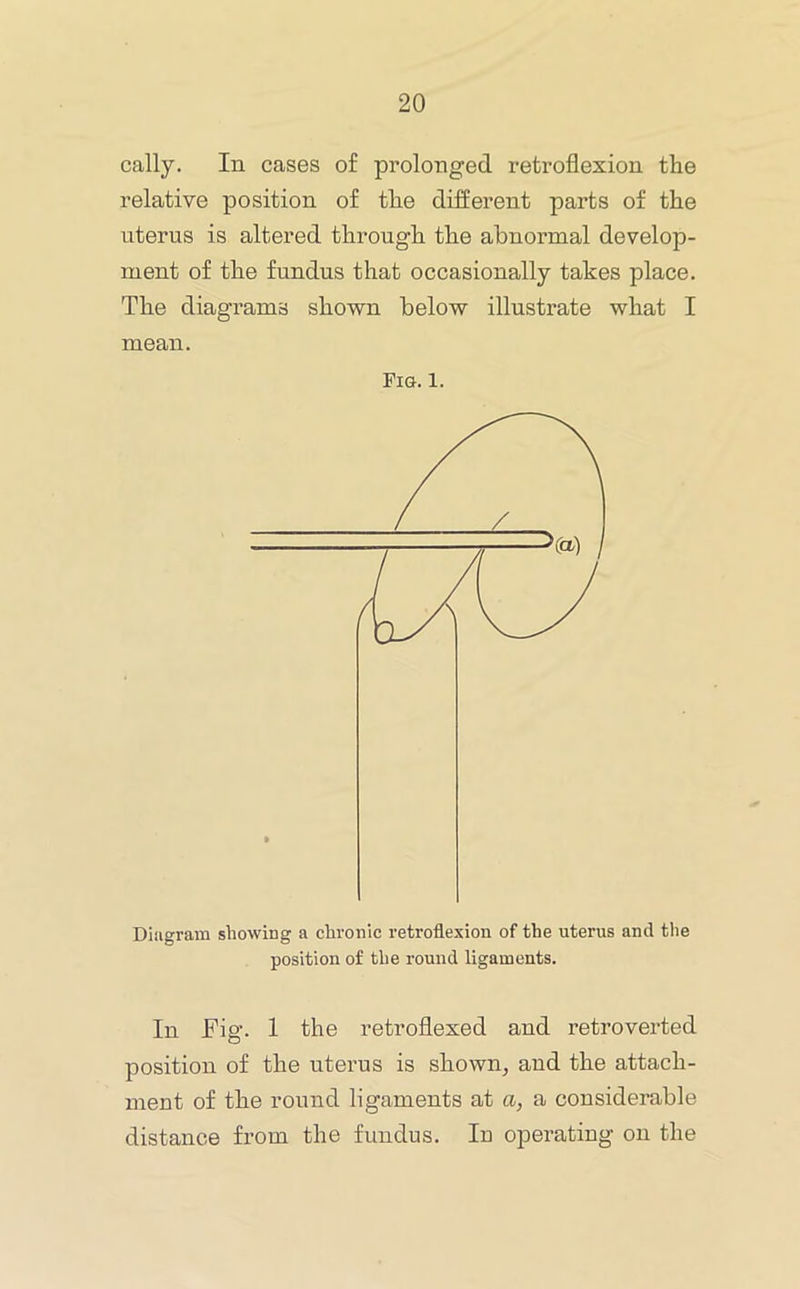 cally. In cases of prolonged retroflexion the relative position of the different parts of the uterus is altered through the abnormal develop- ment of the fundus that occasionally takes place. The diagrams shown below illustrate what I mean. Fig. 1. Diagram showing a chronic retroflexion of the uterus and the position of the round ligaments. In Fig. 1 the retroflexed and retroverted position of the uterus is shown^ and the attach- ment of the round ligaments at a, a considerable distance from the fundus. In operating on the
