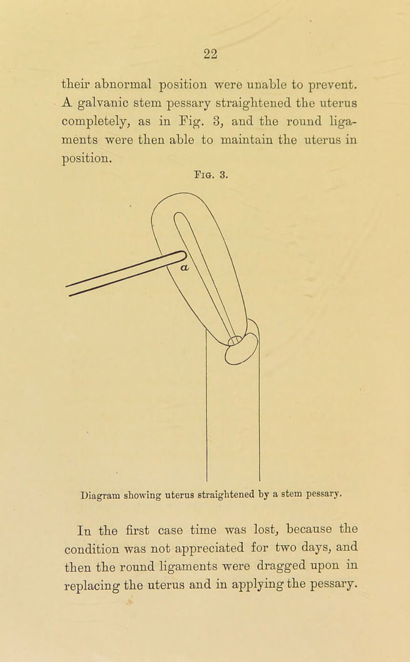 tlieir abnormal position were unable to prevent. A galvanic stem pessai’y straightened the uterus completely^ as in Fig. 3, and the round liga- ments were then able to maintain the uterus in position. Fia. 3. Diagram showing uterus straightened by a stem pessary. In the first case time was lost^ because the condition was not appreciated for two days^ and then the round ligaments were dragged upon in replacing the uterus and in applying the pessary.