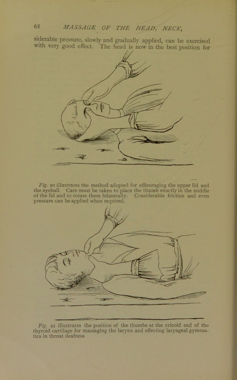 siderable pressure, slowly and gradually applied, can be exercised with very good effect. The head is now in the best position for Fig. 20 illustrates the method adopted for effleuraging the upper lid and the eyeball Care must be taken to place the thumb exactly in the middle of the lid and to rotate them bilaterally. Considerable friction and even pressure can be applied when required. Fig. 21 illustrates the position of the thumbs at the cricoid end of the thyroid cartilage for massaging the larynx and effecting laryngeal gymnas- tics in throat deafness