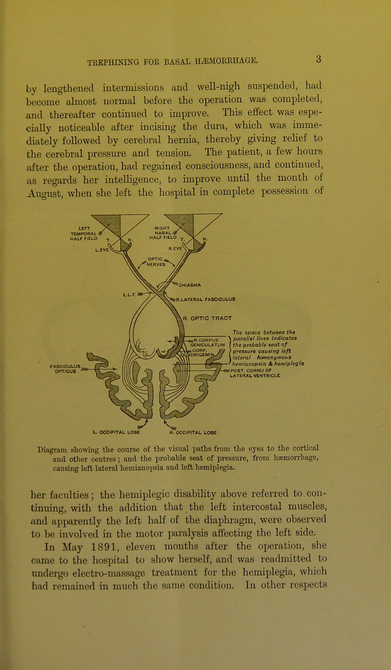 by lengthened intermissions and well-nigh suspended, had become almost normal before the operation was completed, and thereafter continued to improve. This effect was espe- cially noticeable after incising the dura, which was imme- diately followed by cerebral hernia, thereby giving relief to the cerebral pressure and tension. The patient, a few hours after the operation, had regained consciousness, and continued, as regards her intelligence, to improve until the month of August, when she left the hospital in complete possession of ia L. OCCIPITAL LOBE R. OCCIPITAL LOBE Diagram showing the course of the visual paths from the eyes to the cortical and other centres; and the probable seat of pressure, from hemorrhage, causing left lateral hemianopsia and left hemiplegia. her facidties; the hemiplegic disability above referred to con- tinuing, with the addition that the left intercostal muscles, and apparently the left half of the diaphragm, were observed to be involved in the motor paralysis affecting the left side. In May 1891, eleven months after the operation, she came to the hospital to show herself, and was readmitted to undergo electro-massage treatment for the hemiplegia, which had remained in much the same condition. In other respects