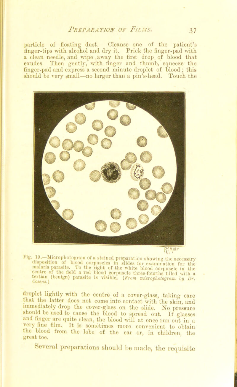 Preparation of Films. particle of floating dust. Cleanse one of the patient’s finger-tips with alcohol and dry it. Prick the finger-pad with a clean needle, and wipe away the first drop of blood that exudes. Then gently, with finger and thumb, squeeze the finger-pad and express a second minute droplet of blood; this should he very small—no larger than a pin’s-head. Touch the f^uir Fig. 19. Microphotogram of a stained preparation showing tlie'necessary disposition of blood corpuscles in slides for examination for the malaria parasite. To the right of the white blood corpuscle in the centre of the field a red blood corpuscle three-fourths filled with a tertian (benign) parasite is visible. (From microphotogram by Dr. droplet lightly with the centre of a cover-glass, taking care that the latter does not come into contact with the skin, and immediately drop the cover-glass on the slide. No pressure should be used to cause the blood to spread out. If glasses and finger arc quite clean, the blood will at once run out in a very fine film. It is sometimes more convenient to obtain the blood from the lobe of the ear or, in children the great toe. Several preparations should he made, the requisite