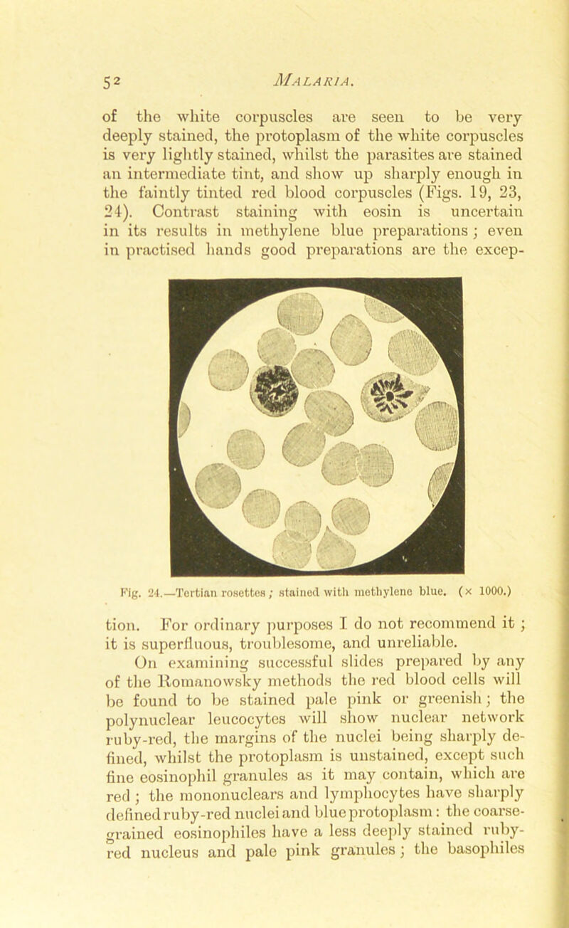 of the white corpuscles are seen to be very deeply stained, the pi'otoplasm of the white corpuscles is very lightly stained, whilst the parasites are stained an intermediate tint, and show up sharply enough in the faintly tinted red blood corpuscles (Figs. 19, 23, 24). Contrast staining with eosin is uncertain in its results in methylene blue preparations; even in practised hands good preparations are the excep- Fig. 24.—Tertian rosettes; stained with methylene blue, (x 1000.) tion. For ordinary purposes I do not recommend it ; it is superfluous, troublesome, and unreliable. On examining successful slides prepared by any of the Romanowsky methods the red blood cells will be found to be stained pale pink or greenish; the polynuclear leucocytes will show nuclear network ruby-red, the margins of the nuclei being sharply de- fined, whilst the protoplasm is unstained, except such fine eosinophil granules as it may contain, which are red ; the mononuclears and lymphocytes have sharply defined ruby-red nuclei and blue protoplasm : the coarse- grained eosinophiles have a less deeply stained ruby- red nucleus and pale pink granules ] the basophiles