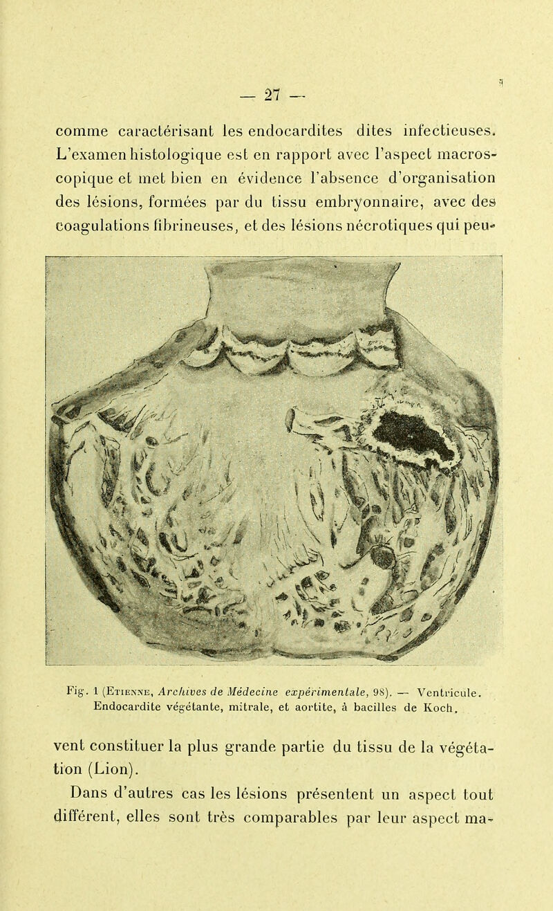 comme caractérisant les endocardites dites infectieuses. L'examen histologique est en rapport avec l'aspect macros- copique et met bien en évidence l'absence d'organisation des lésions, formées par du tissu embryonnaire, avec des coagulations fibrineuses, et des lésions nécrotiques qui peu- Fig. 1 (Etienne, Archives de Médecine expérimentale, 9S). — Ventricule. Endocardite végétante, mitrale, et aortite, à bacilles de Koch. vent constituer la plus grande partie du tissu de la végéta- tion (Lion). Dans d'autres cas les lésions présentent un aspect tout différent, elles sont très comparables par leur aspect ma-