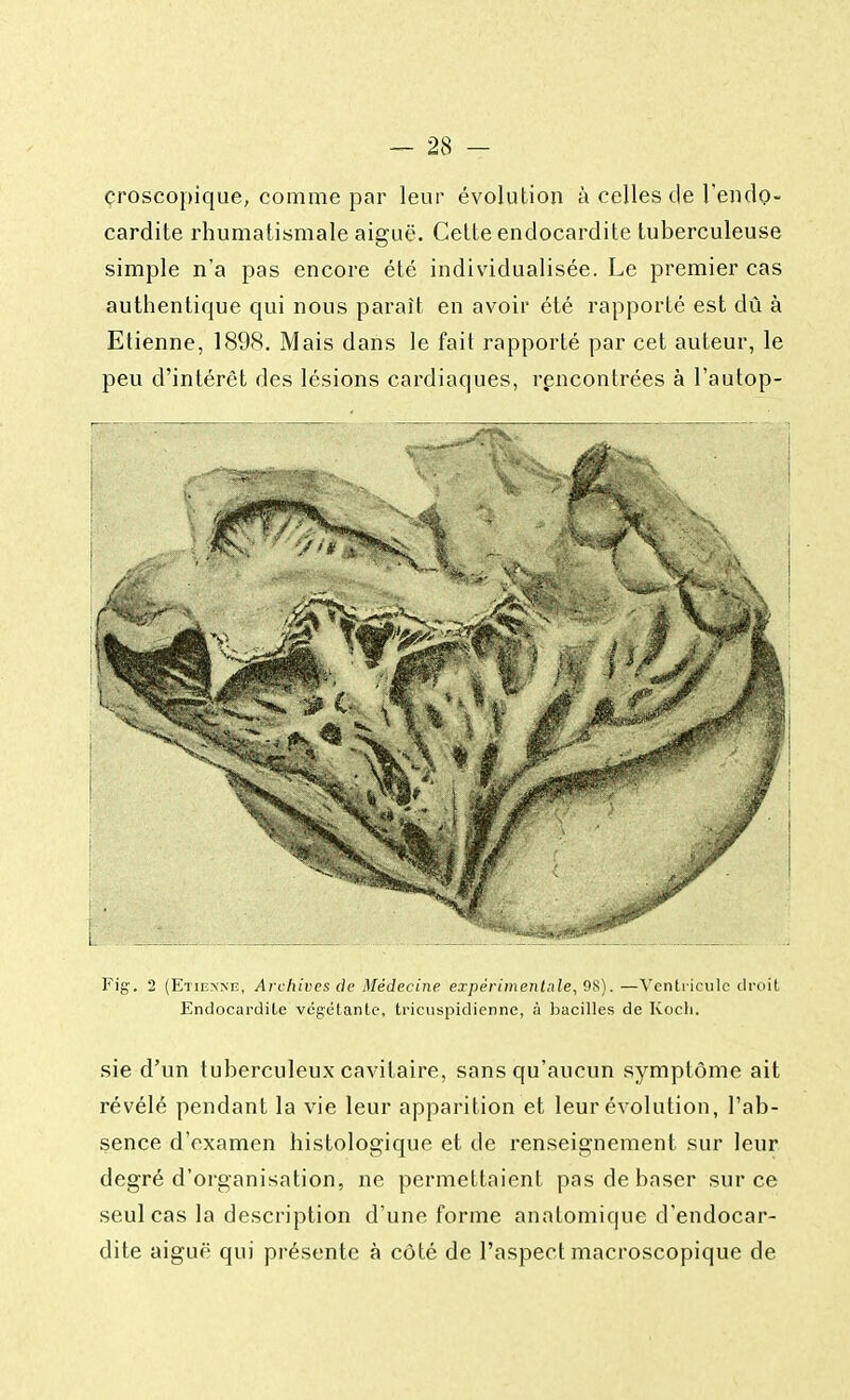 croscopique, comme par leur évolution à celles de l'endo- cardite rhumatismale aiguë. Cette endocardite tuberculeuse simple n'a pas encore été individualisée. Le premier cas authentique qui nous paraît en avoir été rapporté est dû à Etienne, 1898. Mais dans le fait rapporté par cet auteur, le peu d'intérêt des lésions cardiaques, rencontrées à l'autop- Fig. 2 (Etienne, Archives de Médecine expérimentale, 98). —Ventricule droit Endocardite végétante, tricuspidienne, à bacilles de Kocli. sie d'un tuberculeux cavitaire, sans qu'aucun symptôme ait révélé pendant la vie leur apparition et leur évolution, l'ab- sence d'examen histologique et de renseignement sur leur degré d'organisation, ne permettaient pas de baser sur ce seul cas la description d'une forme anatomique d'endocar- dite aiguë qui présente à côté de l'aspect macroscopique de