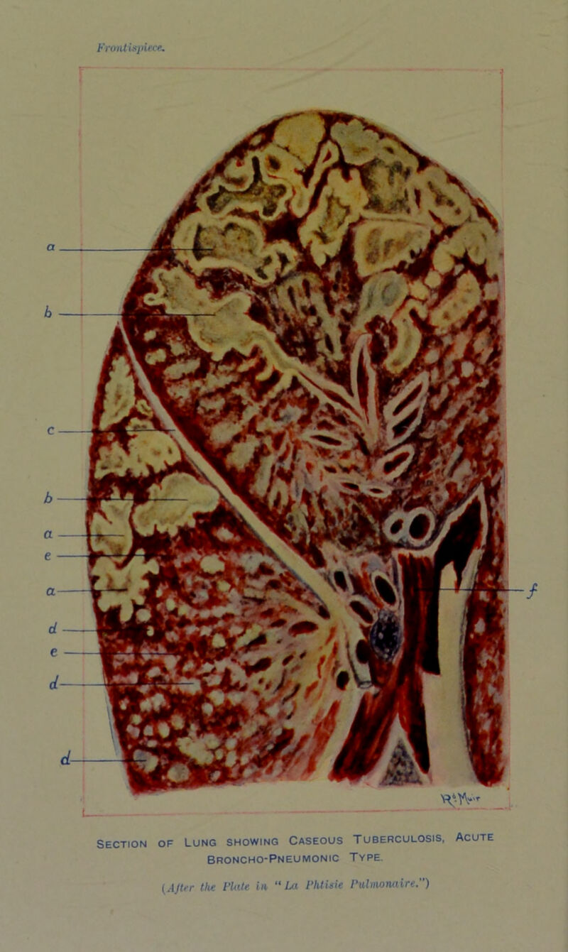 Section of Lung showing Caseous Tuberculosis, Acute Broncho-Pneumonic Type. {AJtrr the Flute in ‘‘La FhtUie Fulmonaire.)