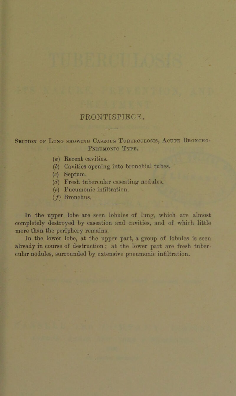 FRONTISPIECE. Section of Lung showing Caseous Tubf,hcuuosis, Acute Broncho- Pneumonic Ttfe. (a) Recent ca\'ities. (b) Cavities opening into bronchial tubes. (c) Septum. (rf) Fresh tubercular caseating nodules. (e) Pneumonic infiltration. (/} Bronchus. In the upper lohe are seen lobules of lung, which are almost completely destroyed by caseation and cavities, and of which little more than the periphery remains. In the lower lobe, at the upper part, a group of lobules is seen already in course of destruction; at the lower part are fresh tuher- cular nodules, surrounded by extensive pneumonic infiltration.