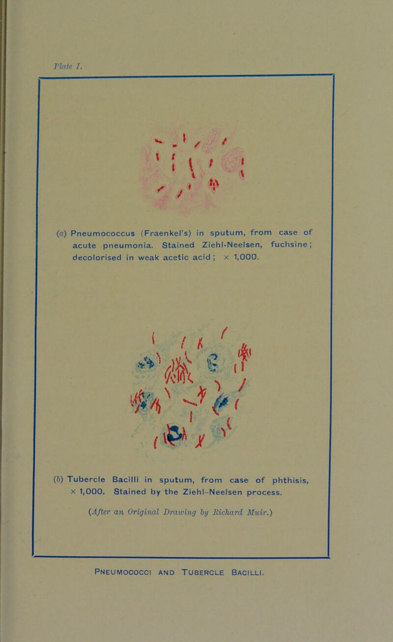 I'latf I. t < I \ (a) Pneumococcus (Fraenkel’s) in sputum, from case of acute pneumonia. Stained Ziehl-Neelsen, fuchsine; decolorised in weak acetic acid ; x 1,000. (b) Tubercle Bacilli in sputum, from case of phthisis, X 1,000. Stained by the Ziehl-Neelsen process. (After an Original Drawing by Richard Muir.) Pneumococci and Tubercle Bacilli.