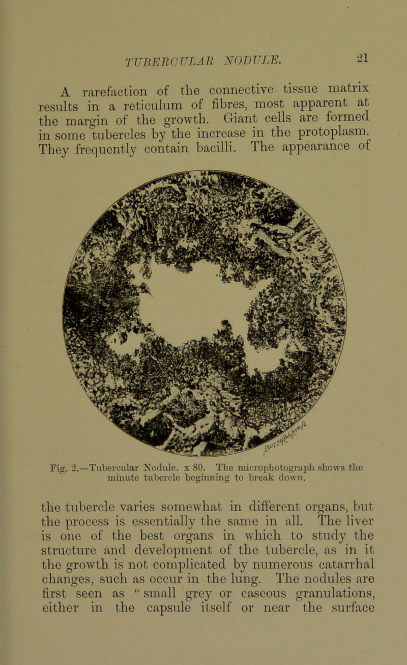 TUBETU'JULA R XODULE. A rarefixction of the connective tissue matrix results in a reticulum of fibres, most apparent at the margin of the growth. Giant cells are formed in some tubercles by the increase in the protoplasm. They frequently contain bacilli. The appearance of Fig. '2.—Tubercular Xoclule. x 80. The microphotograph shows the minute tubercle beginning to break down. the tubercle varies someAvhat in cliftercnt organs, but the process is essentially the same in all. The liver is one of the best organs in -which to study the structure and development of the tubercle, as in it the growth is not complicated by numerous catarrhal changes, such as occur in the lung. The nodules are first seen as “ small grey or caseous granulations, cither in the capsule itself or near the surface