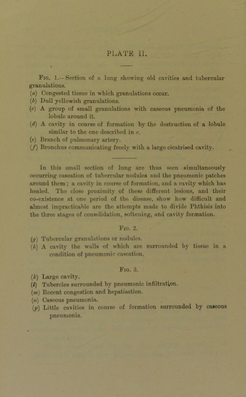 Fig. 1.—Section of a lung .showing old cavities and tubercular granulations. (a) Congested tissue in which granulations occur. (i) Dull yellowish granulations. (c) A group of small gi-anulations with caseous pneumonia of the lobule around it. (rf) A cavity in course of formation by the destruction of a lobule similar to the one described in e. (e) Branch of pulmonary artery. {/) Bronchus communicating freely witli a large cicatrised cavity. In this small section of lung are thus seen simultaneously occurring caseation of tubercular nodules and the pneumonic patches around them; a cavity in course of formation, .and a cavity which has healed. The close proximity of these different lesions, and their co-existence at one period of the disease, show how difficult and almost impracticable are the attempts made to divide Phthisis into the three stages of consolidation, softening, and cavity formation. Fig. 2. {g) Tubercular granulations or nodules. (//) A cavity the walls of which are surrounded by tissue in a condition of pneumonic caseation. Fig. 3. (A:) Large cavity. (i) Tubercles surrounded by pneumonic infilti-ation. (m) Recent congestion and hepatisation. (h) Caseous pneumonia. (p) Little cavities in course of formation surrounded by caseous pneumonia.
